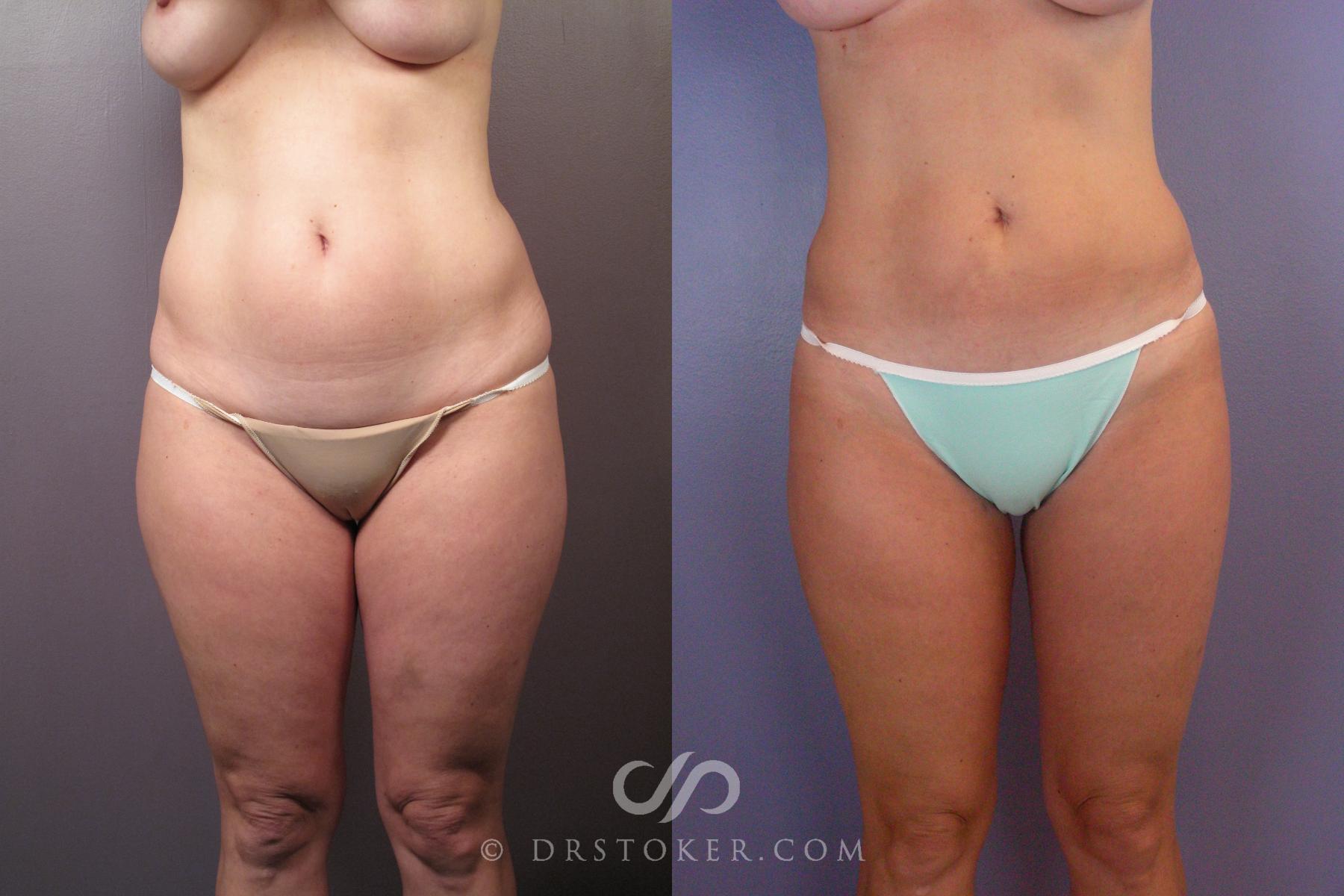 Before & After Liposuction Case 462 View #1 View in Los Angeles, CA