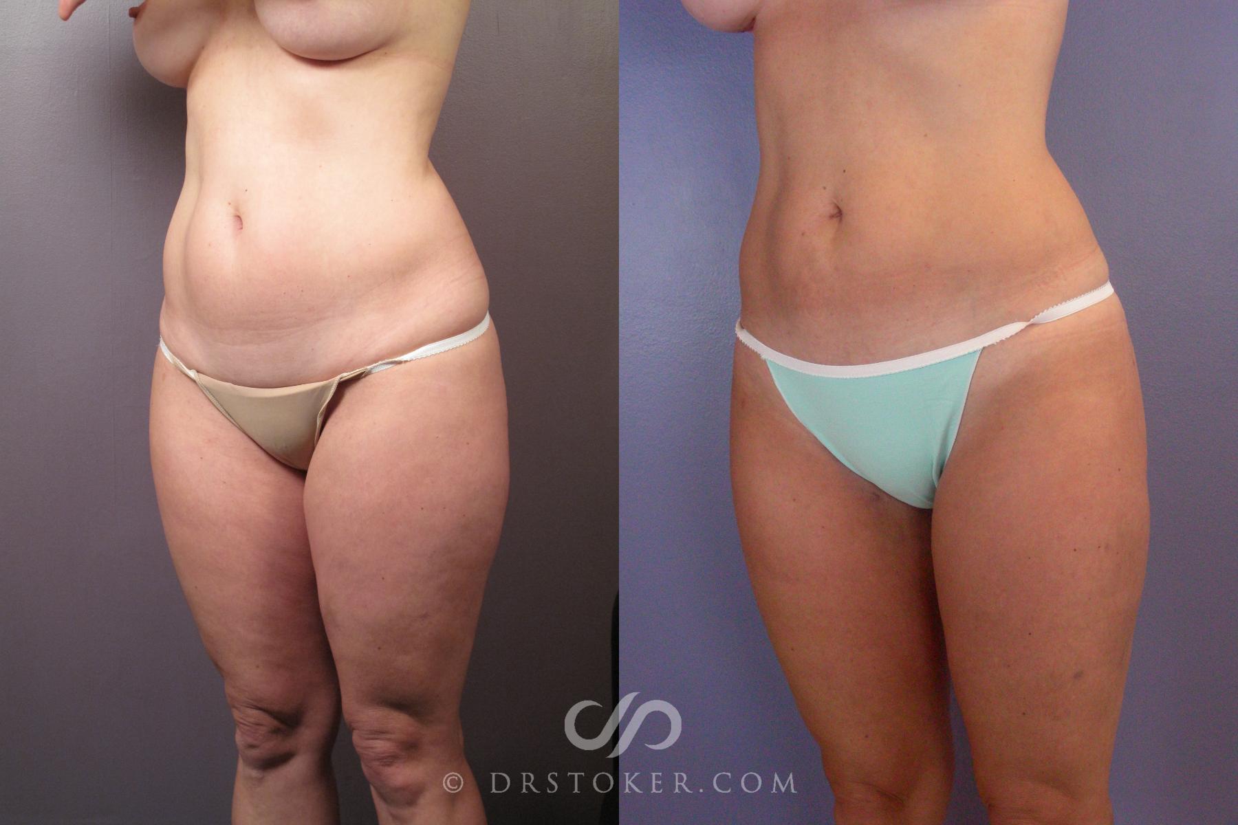 Before & After Liposuction Case 462 View #2 View in Los Angeles, CA