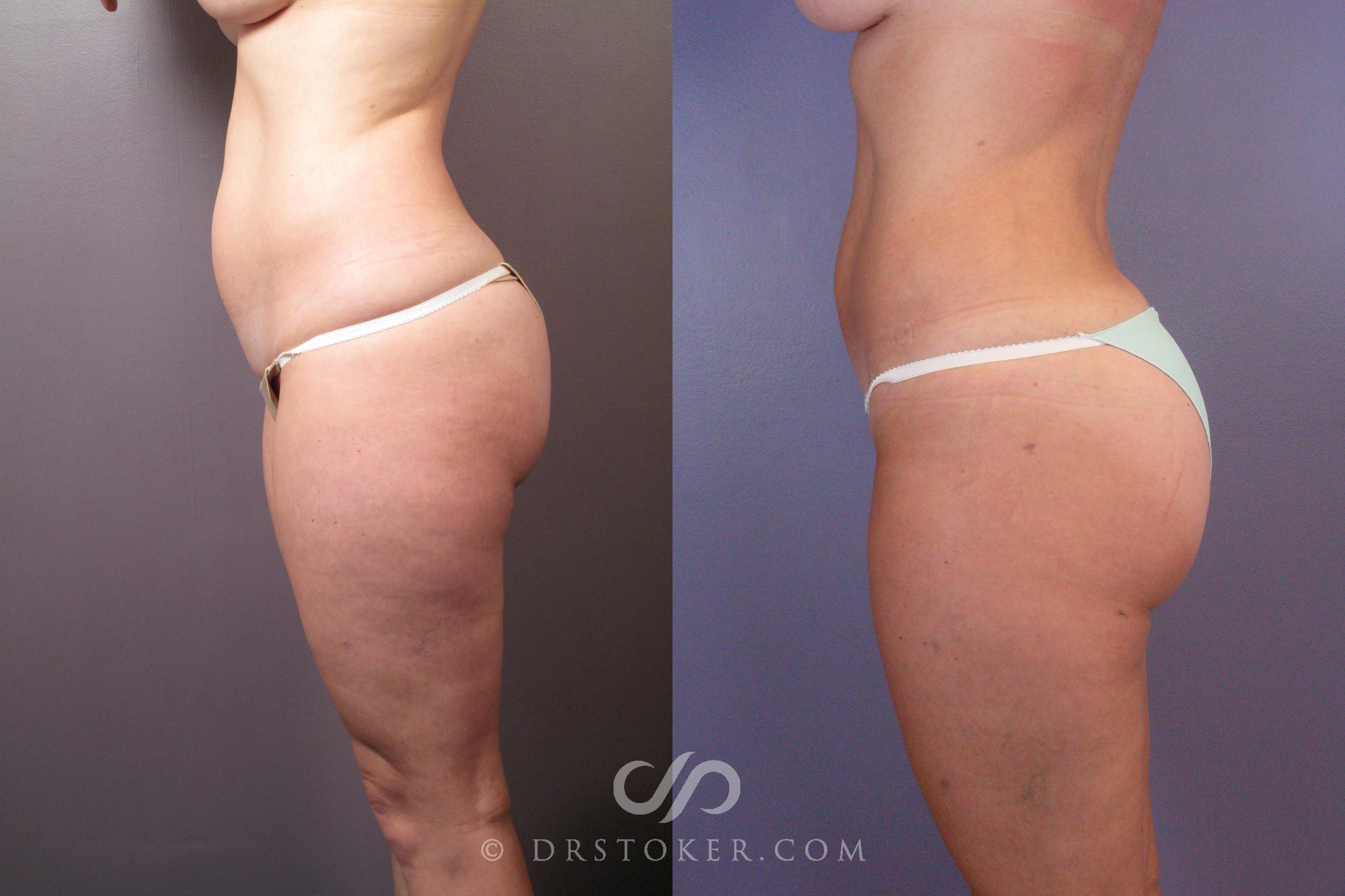 Before & After Liposuction Case 462 View #3 View in Los Angeles, CA