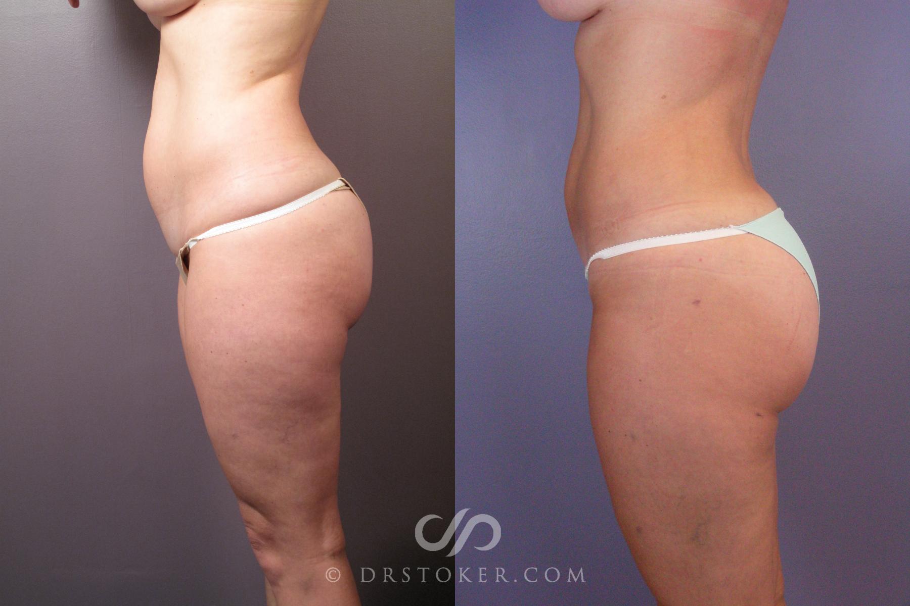Before & After Liposuction Case 462 View #3 View in Los Angeles, CA