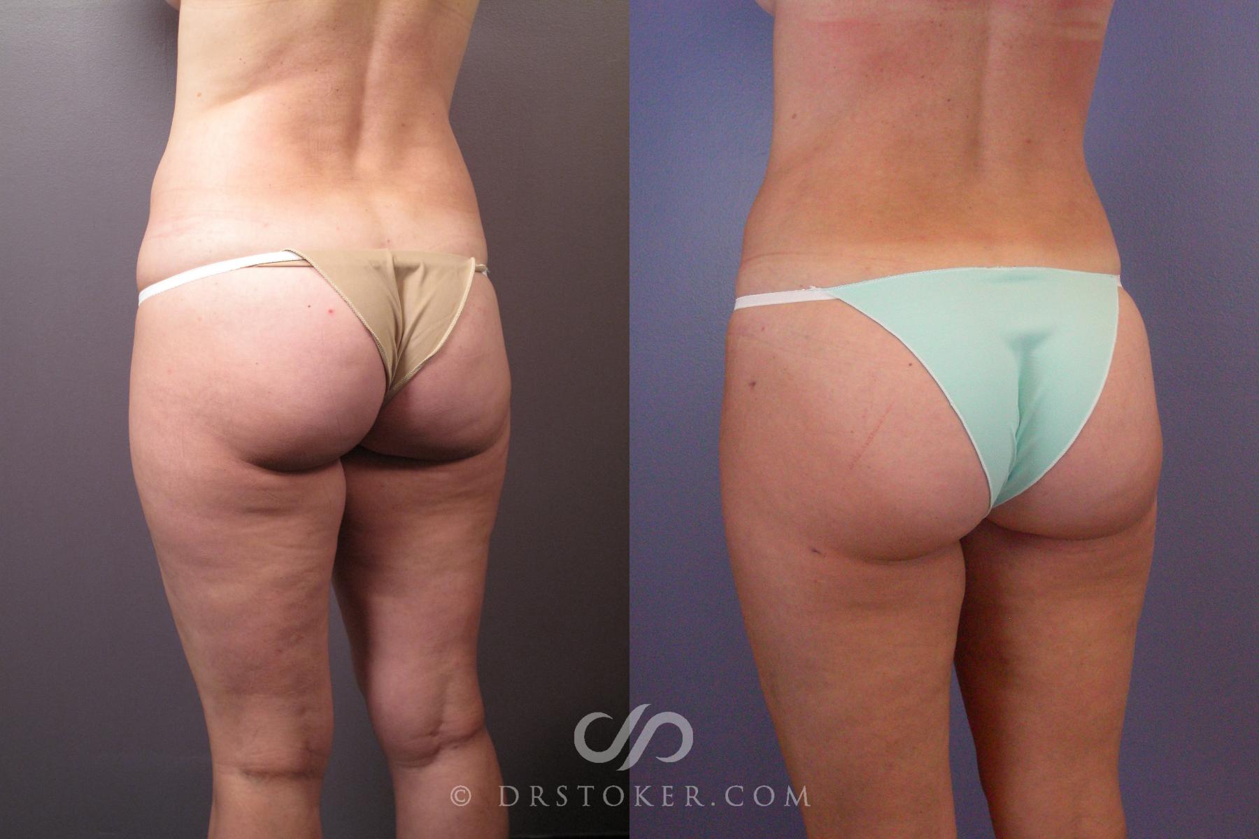Before & After Liposuction Case 462 View #4 View in Los Angeles, CA