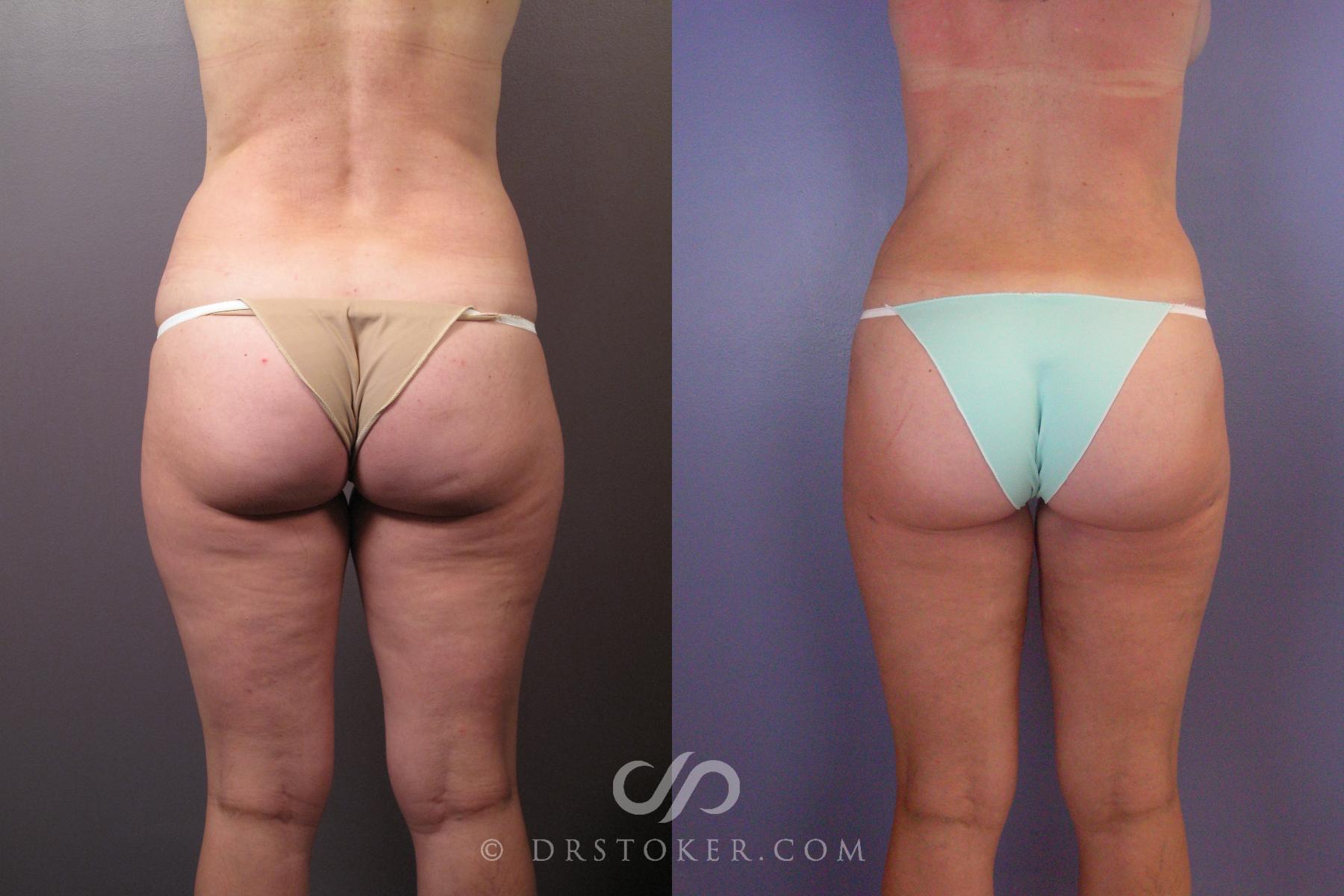 Before & After Liposuction Case 462 View #5 View in Los Angeles, CA
