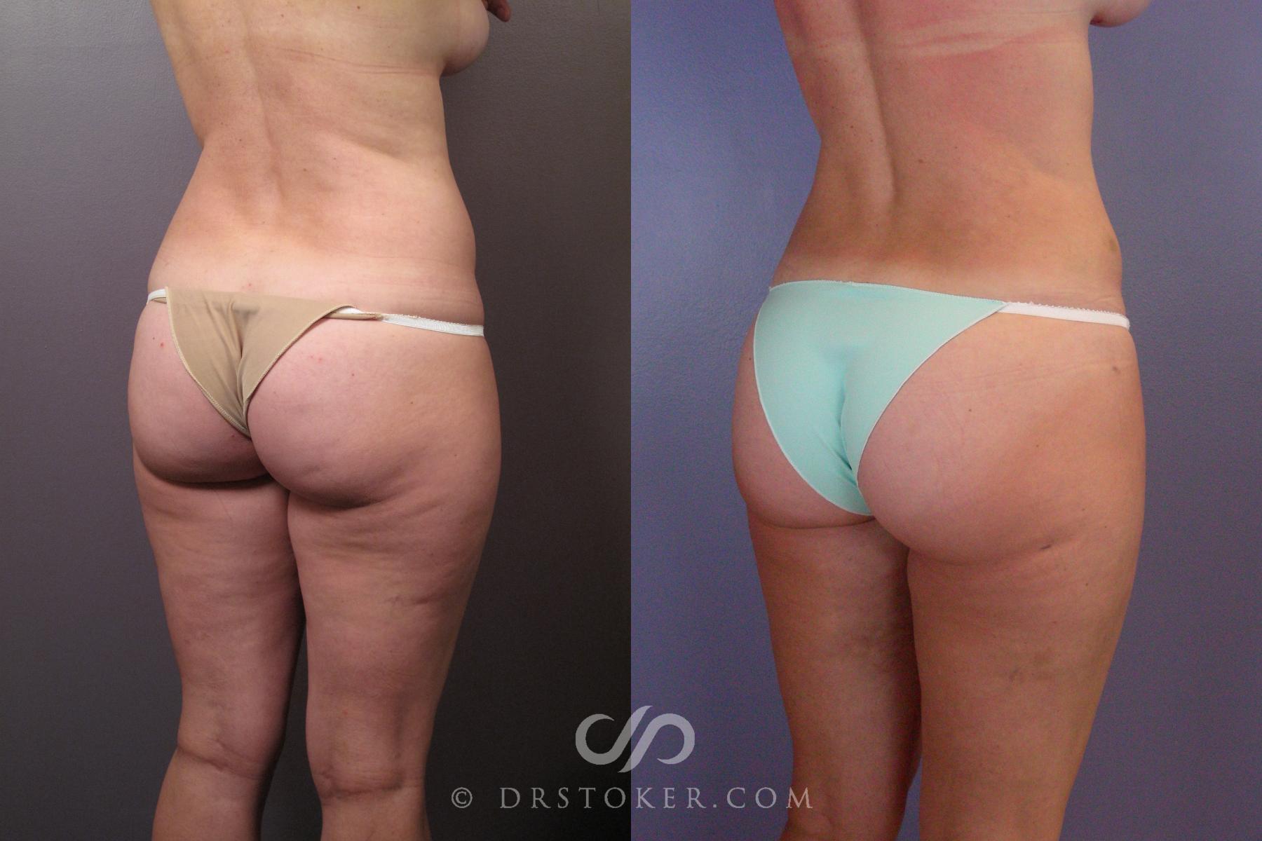 Before & After Liposuction Case 462 View #6 View in Los Angeles, CA