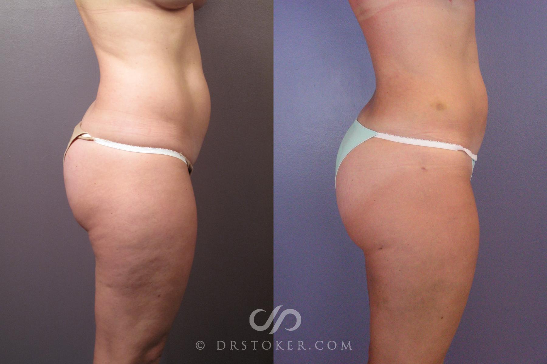Before & After Liposuction Case 462 View #7 View in Los Angeles, CA