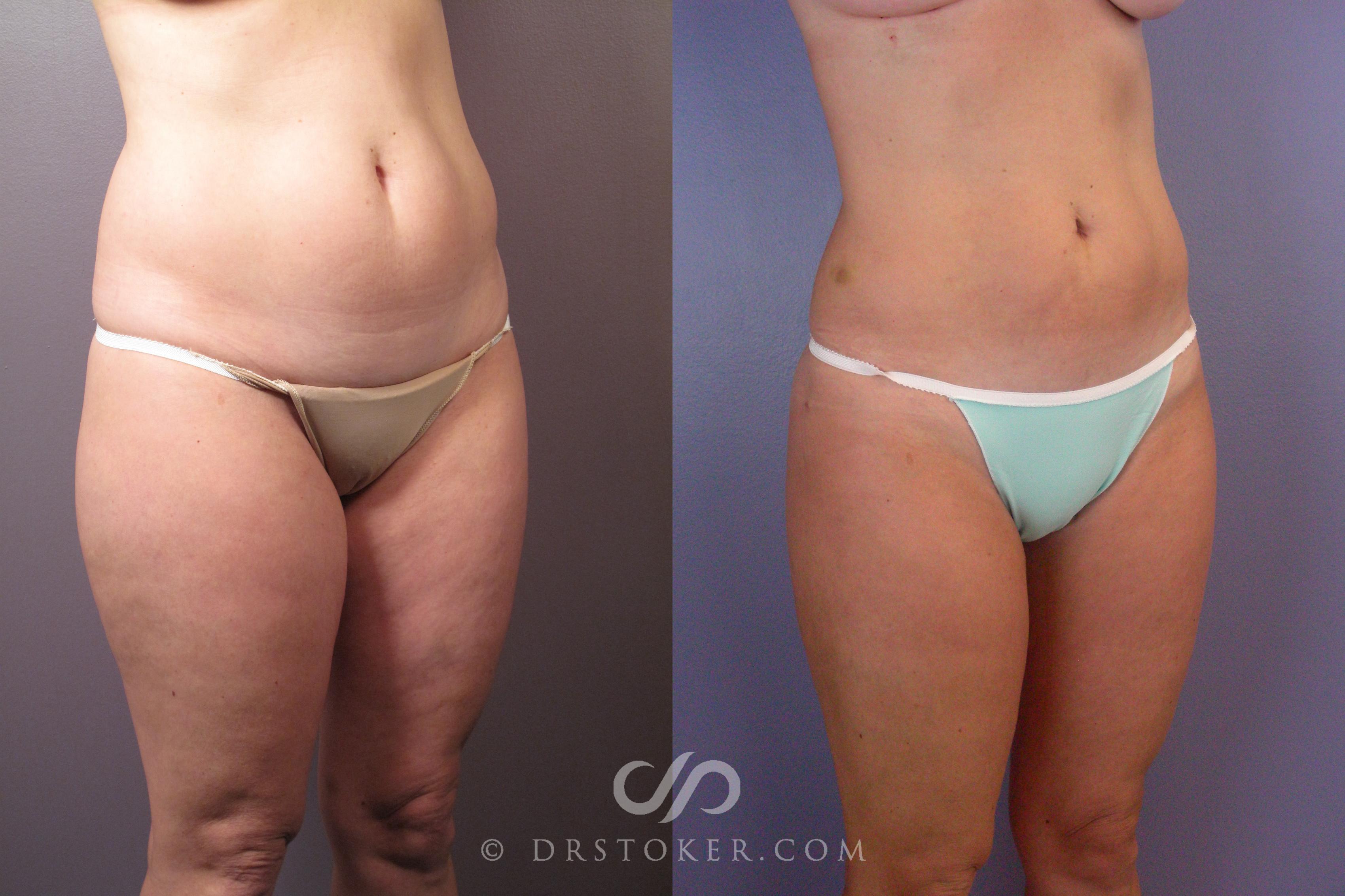 Before & After Liposuction Case 462 View #8 View in Los Angeles, CA