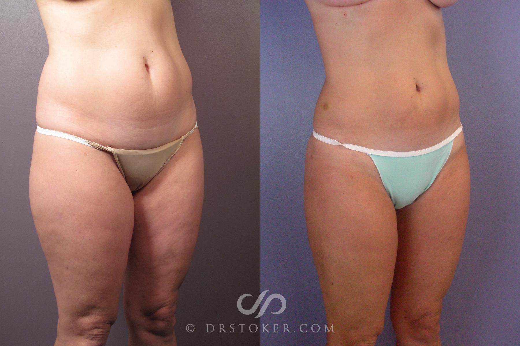 Before & After Liposuction Case 462 View #8 View in Los Angeles, CA