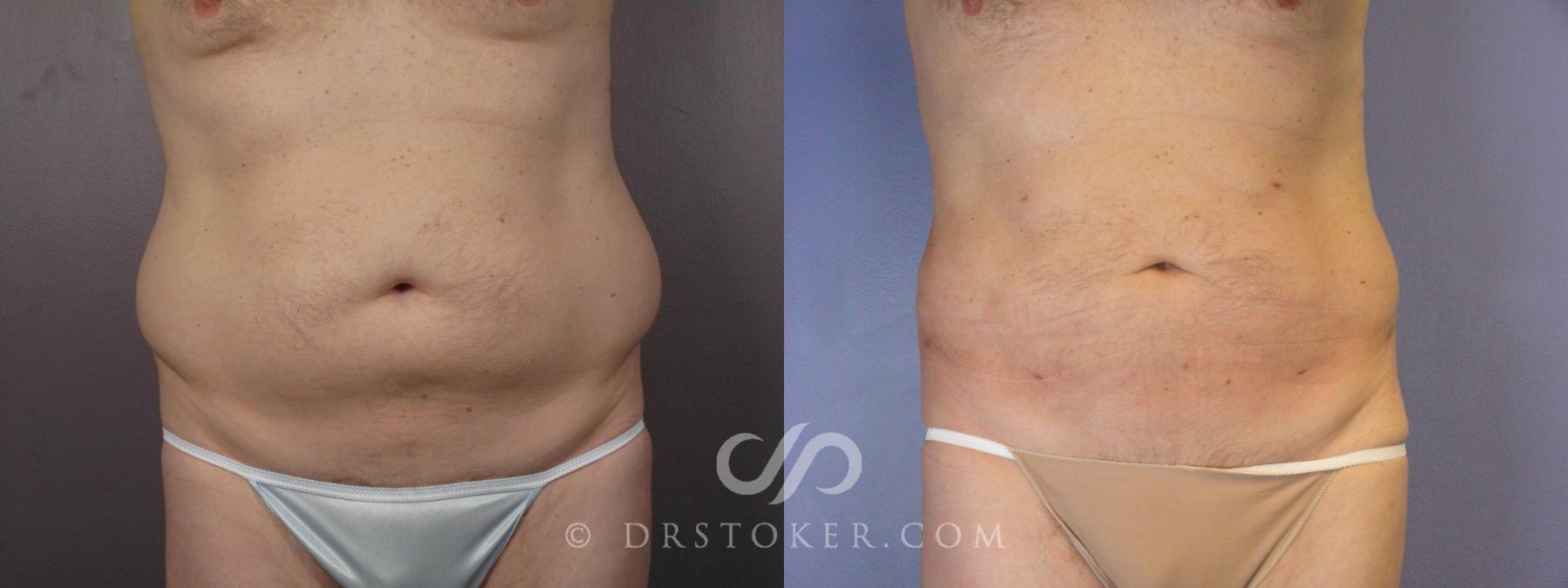 Before & After Liposuction Case 463 View #1 View in Los Angeles, CA