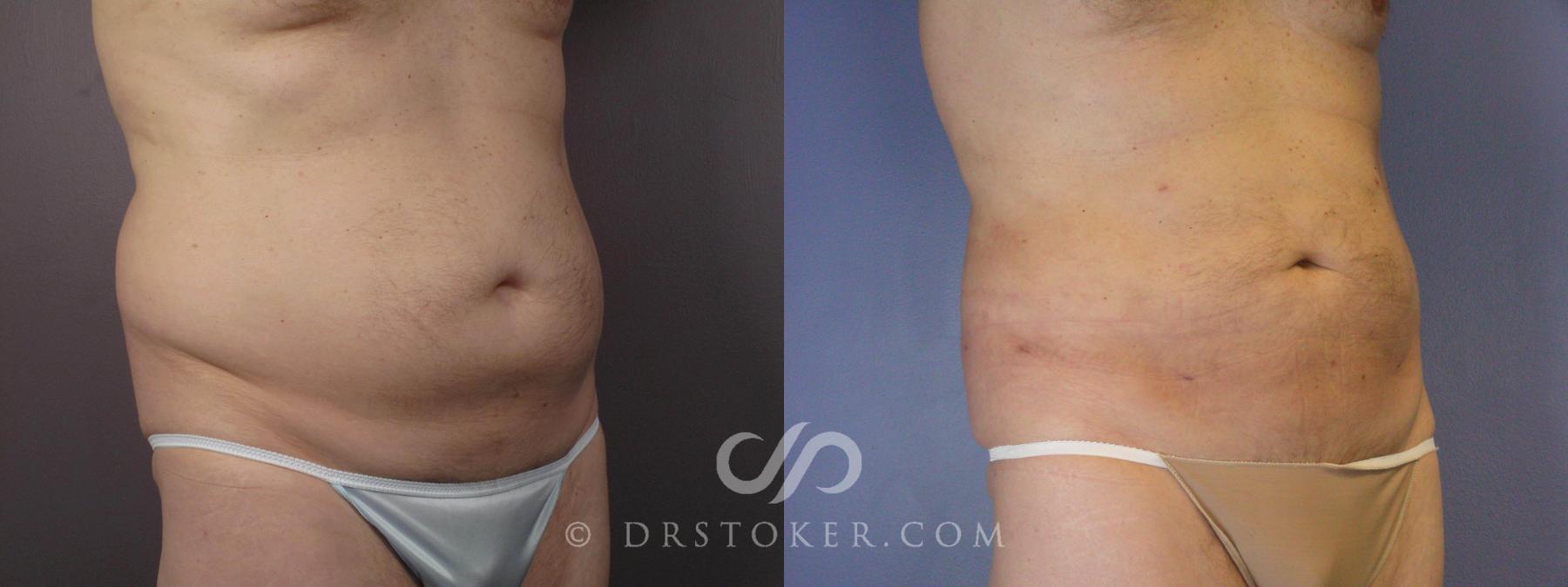 Before & After Liposuction Case 463 View #2 View in Los Angeles, CA