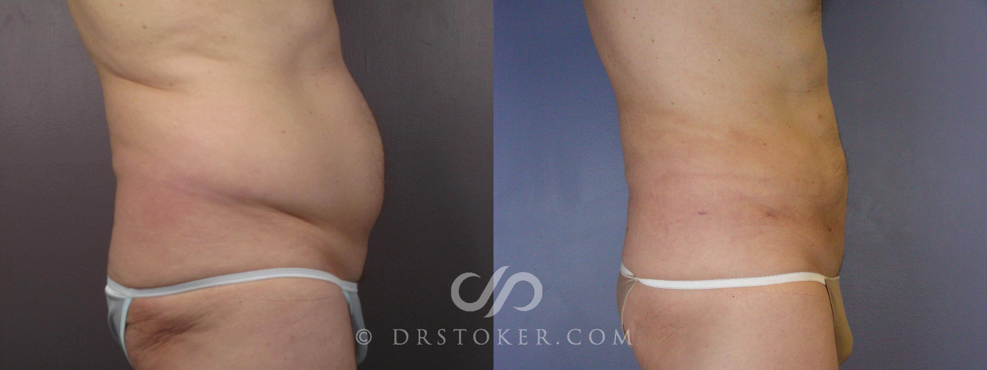 Before & After Liposuction Case 463 View #3 View in Los Angeles, CA