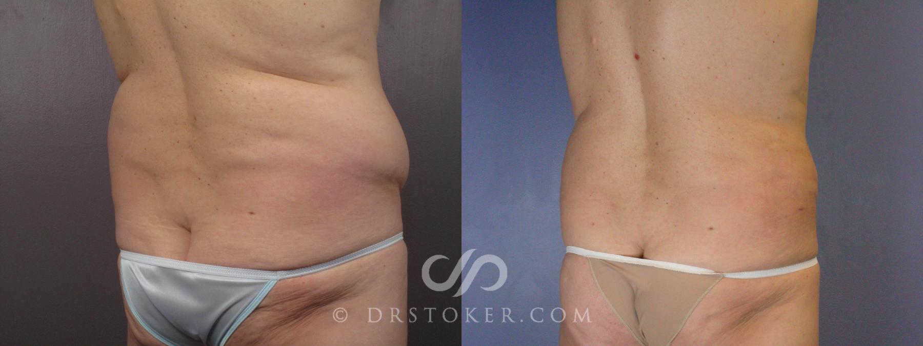 Before & After Liposuction Case 463 View #4 View in Los Angeles, CA