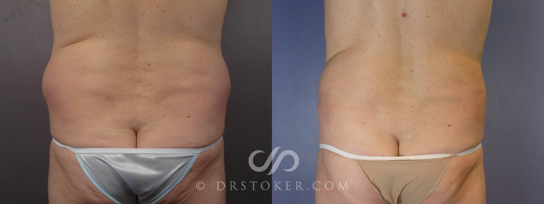 Before & After Liposuction Case 463 View #5 View in Los Angeles, CA