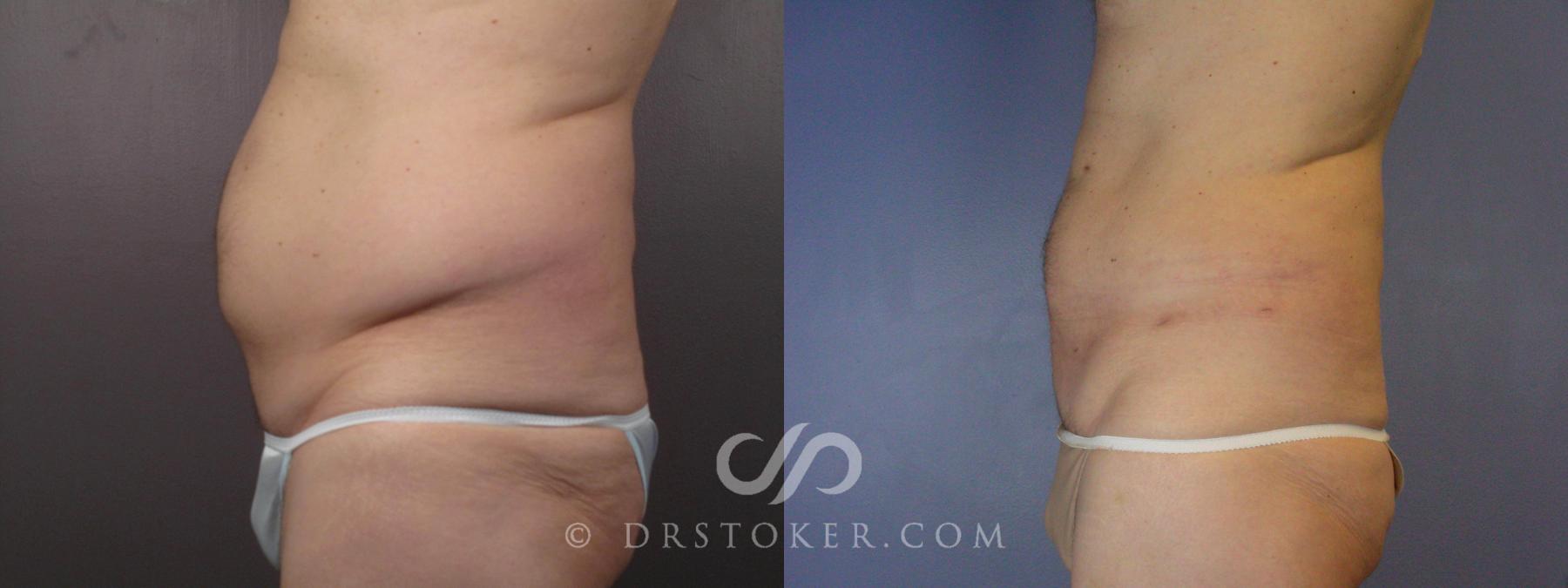 Before & After Liposuction Case 463 View #6 View in Los Angeles, CA