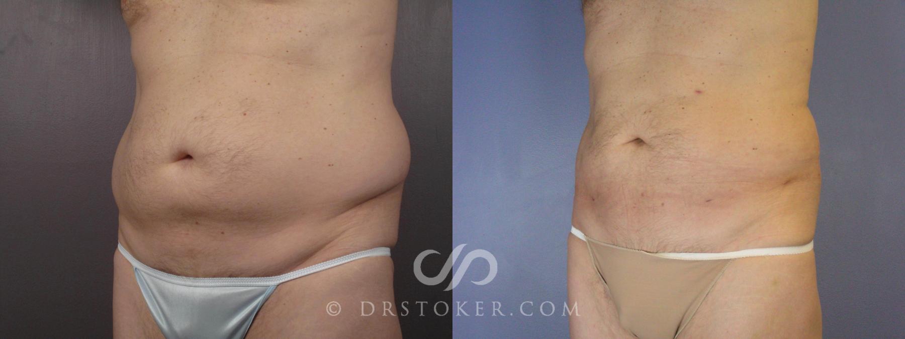 Before & After Liposuction Case 463 View #7 View in Los Angeles, CA