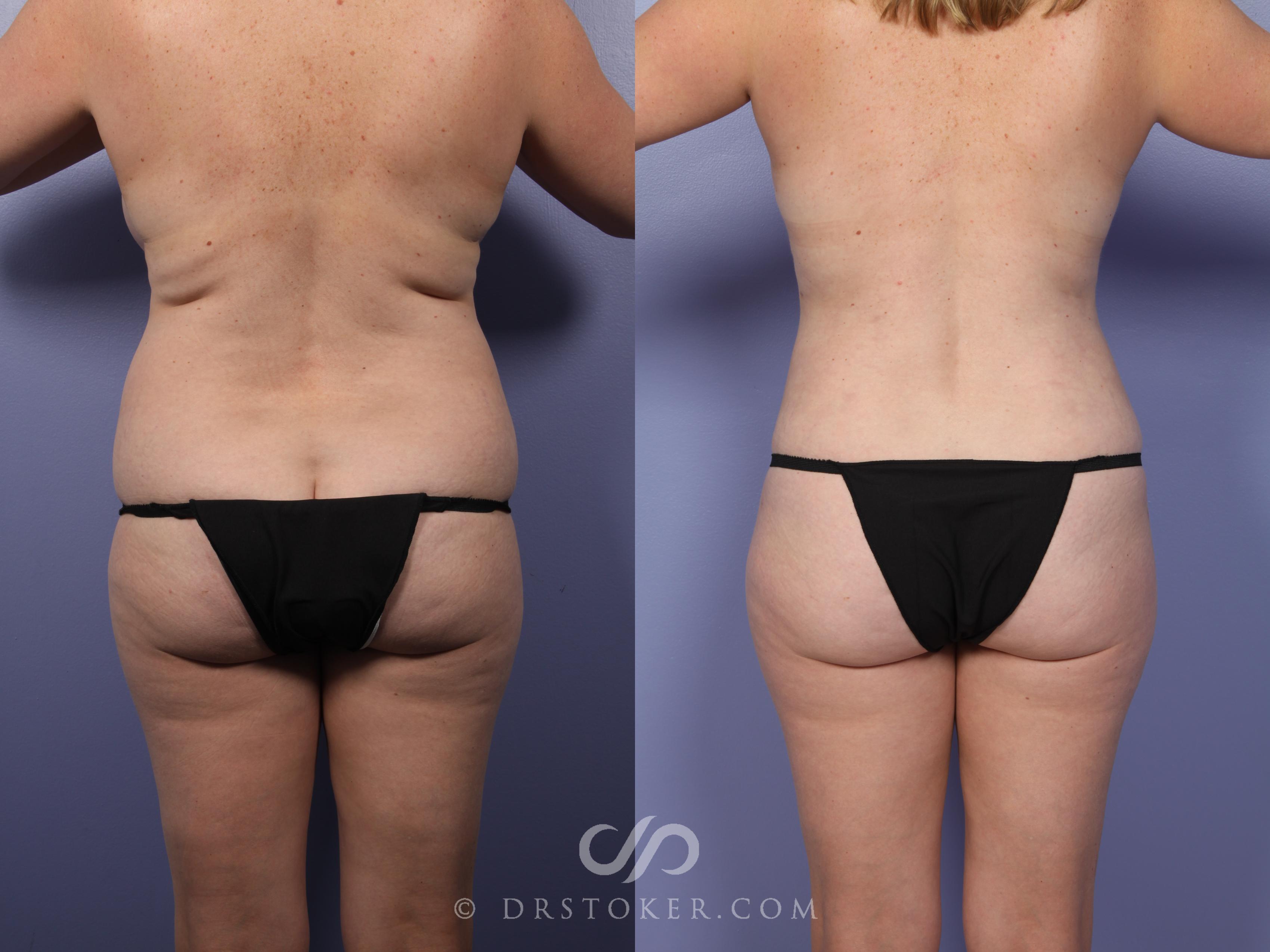 Before & After Liposuction Case 464 View #1 View in Los Angeles, CA