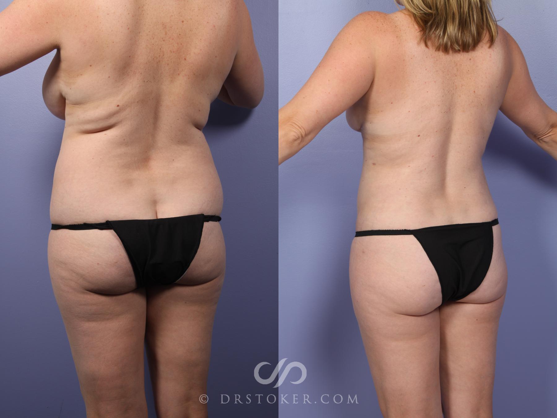 Before & After Liposuction Case 464 View #2 View in Los Angeles, CA