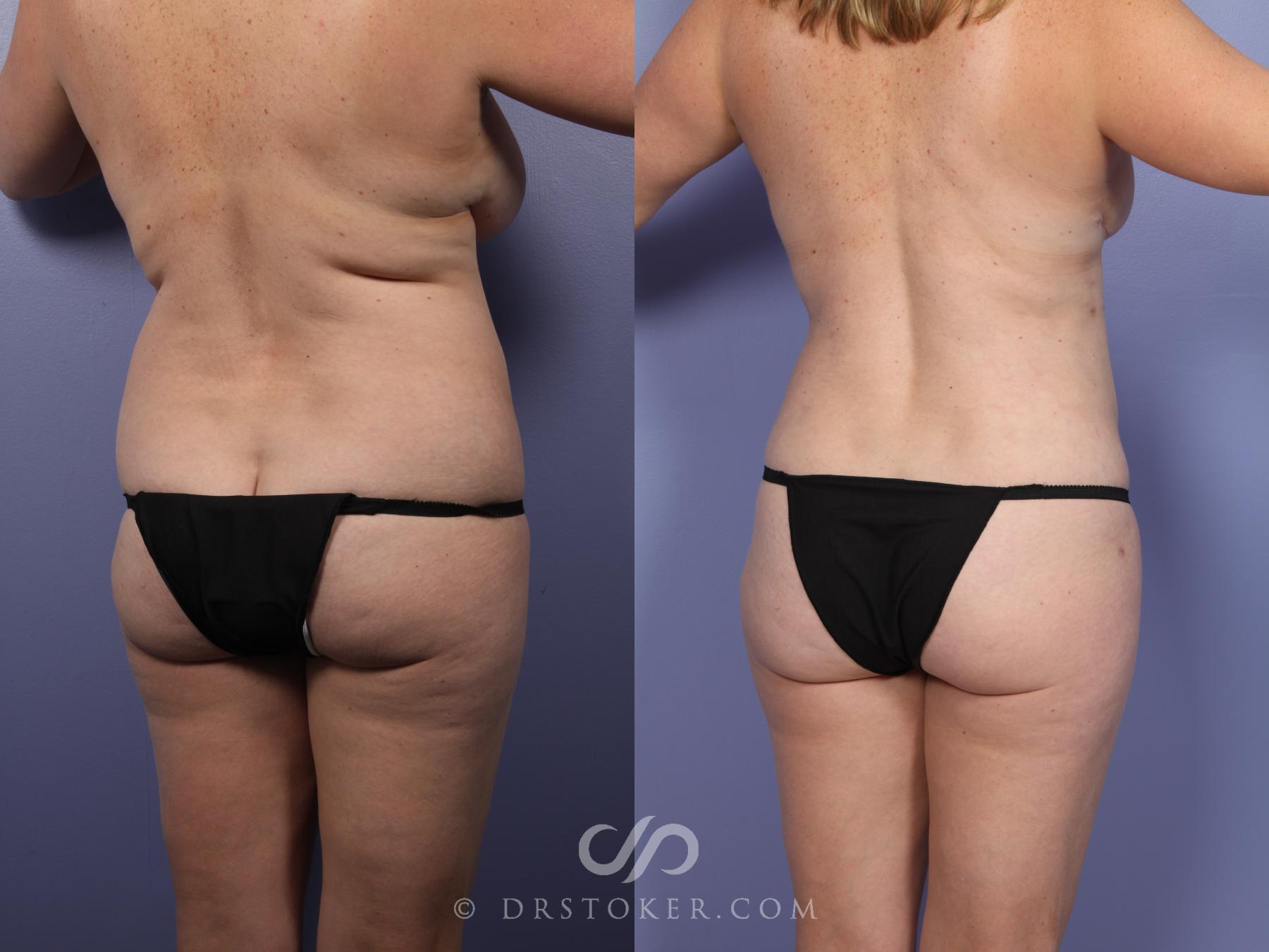 Before & After Liposuction Case 464 View #3 View in Los Angeles, CA