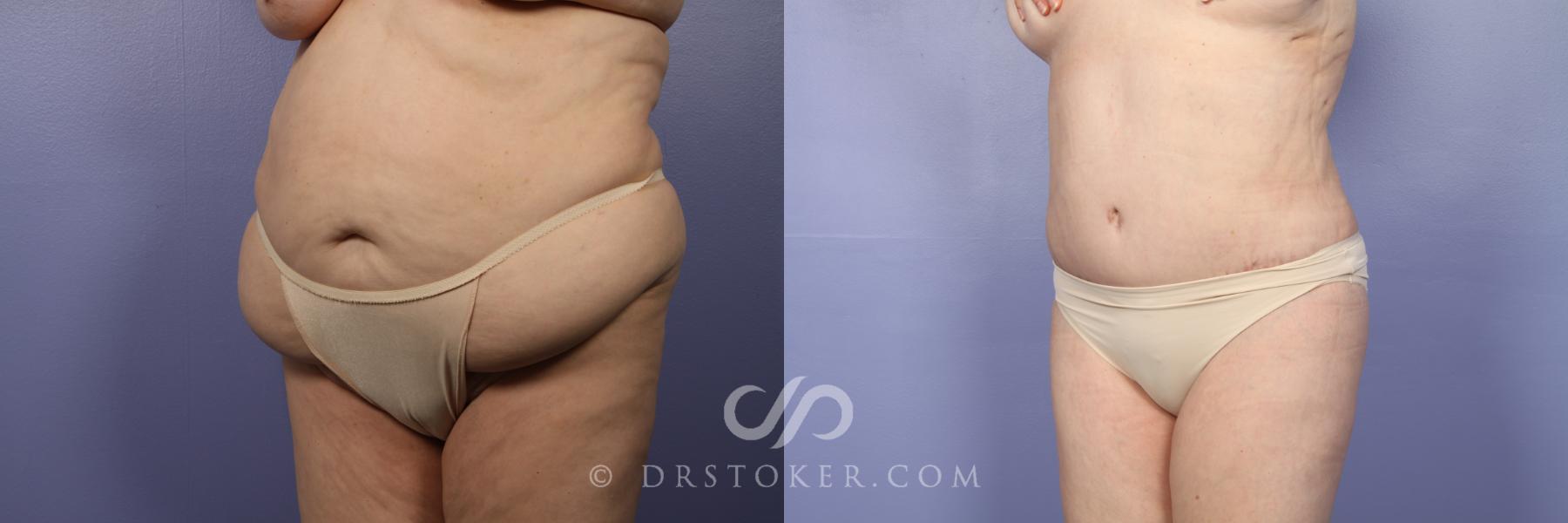 Before & After Liposuction Case 485 View #5 View in Los Angeles, CA