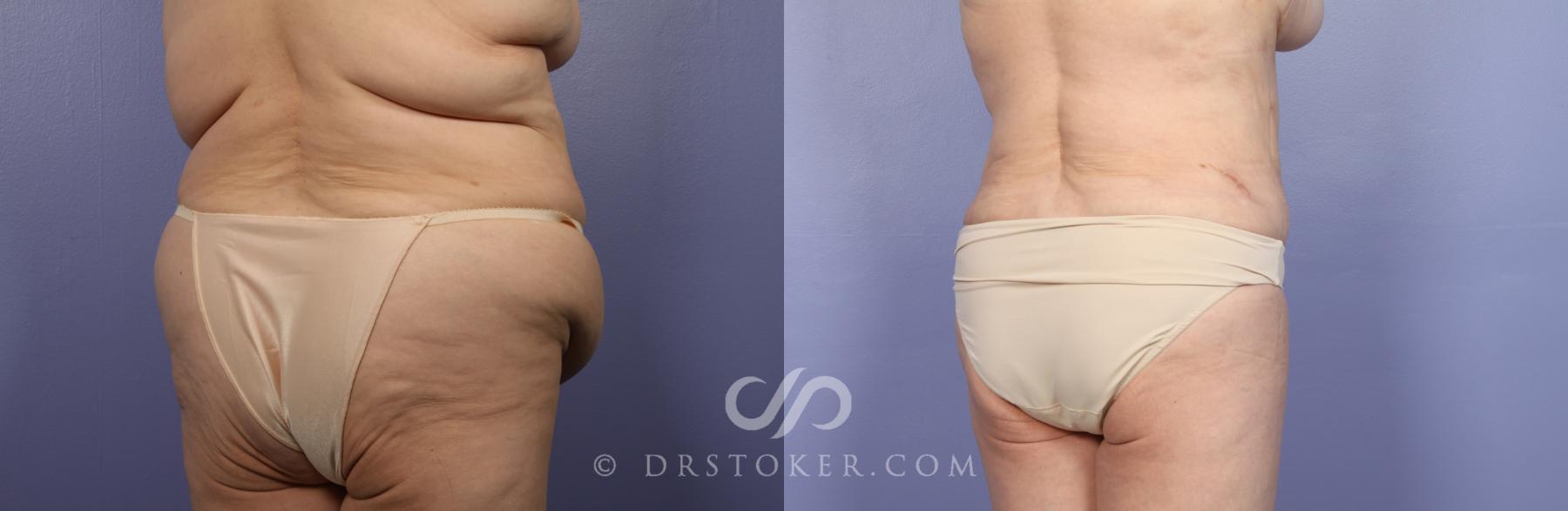 Before & After Liposuction Case 485 View #6 View in Los Angeles, CA