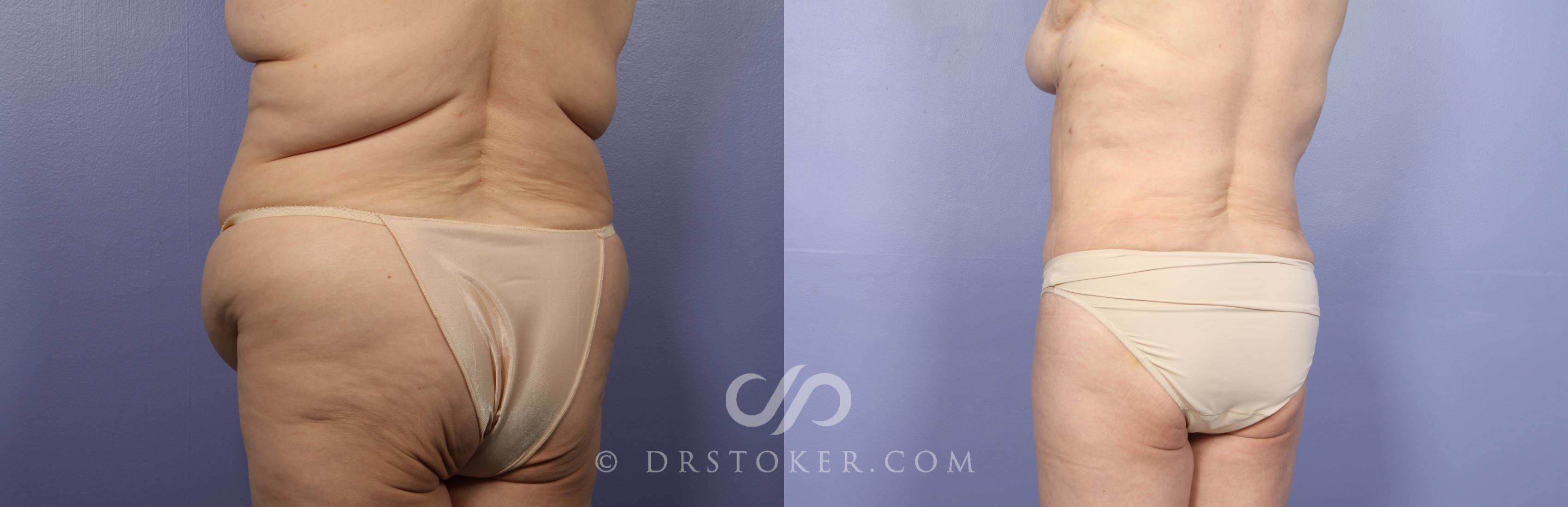 Before & After Tummy Tuck Case 485 View #7 View in Los Angeles, CA