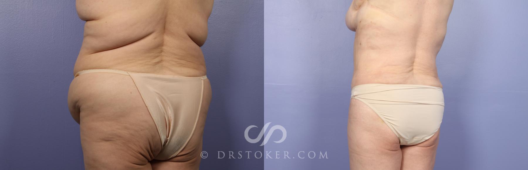 Before & After Tummy Tuck Case 485 View #7 View in Los Angeles, CA