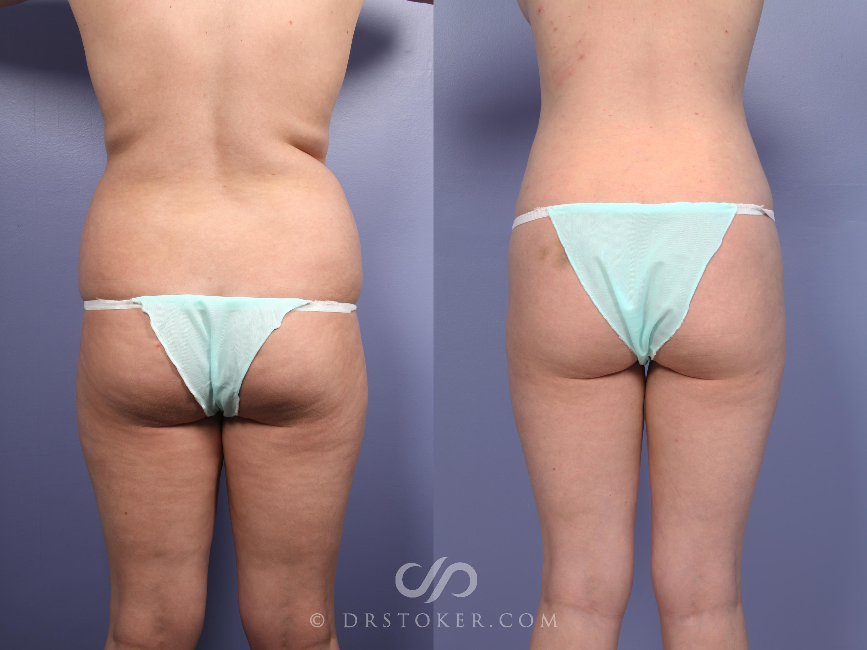 Before & After Liposuction Case 512 View #1 View in Los Angeles, CA