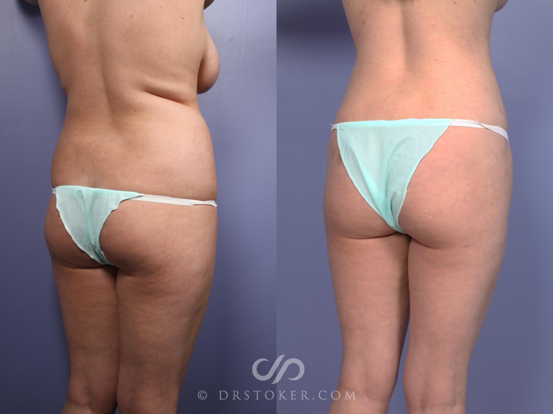 Before & After Liposuction Case 512 View #2 View in Los Angeles, CA