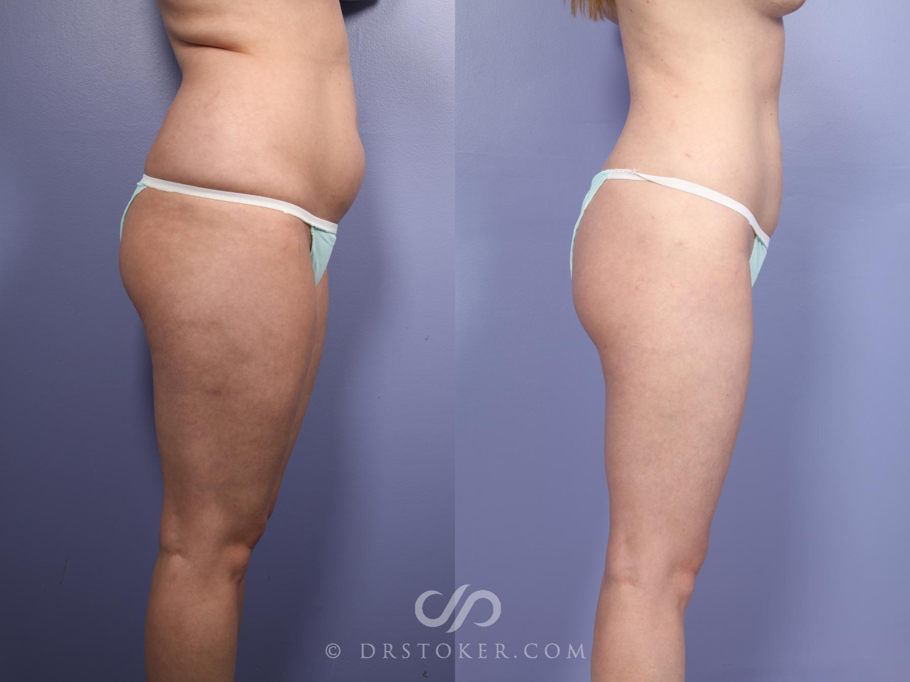 Before & After Liposuction Case 512 View #3 View in Los Angeles, CA