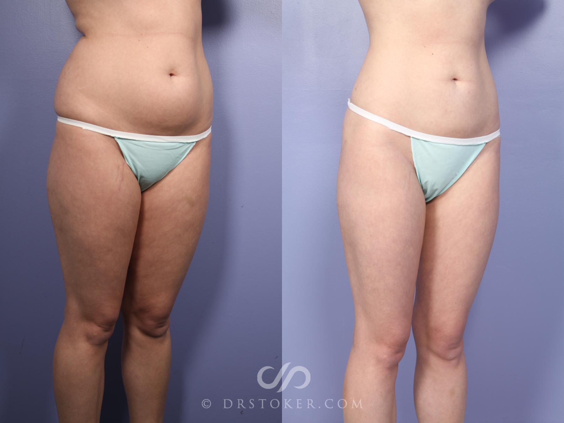 Before & After Liposuction Case 512 View #4 View in Los Angeles, CA