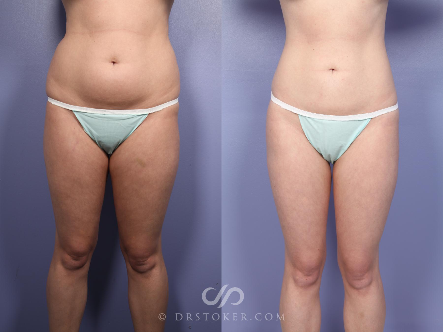 Before & After Liposuction Case 512 View #5 View in Los Angeles, CA