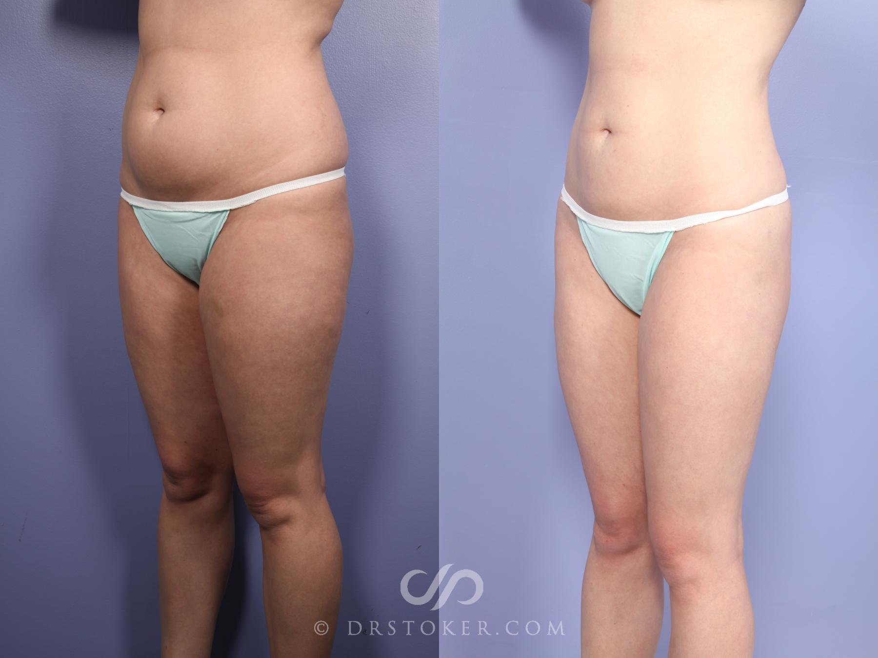 Before & After Liposuction Case 512 View #6 View in Los Angeles, CA