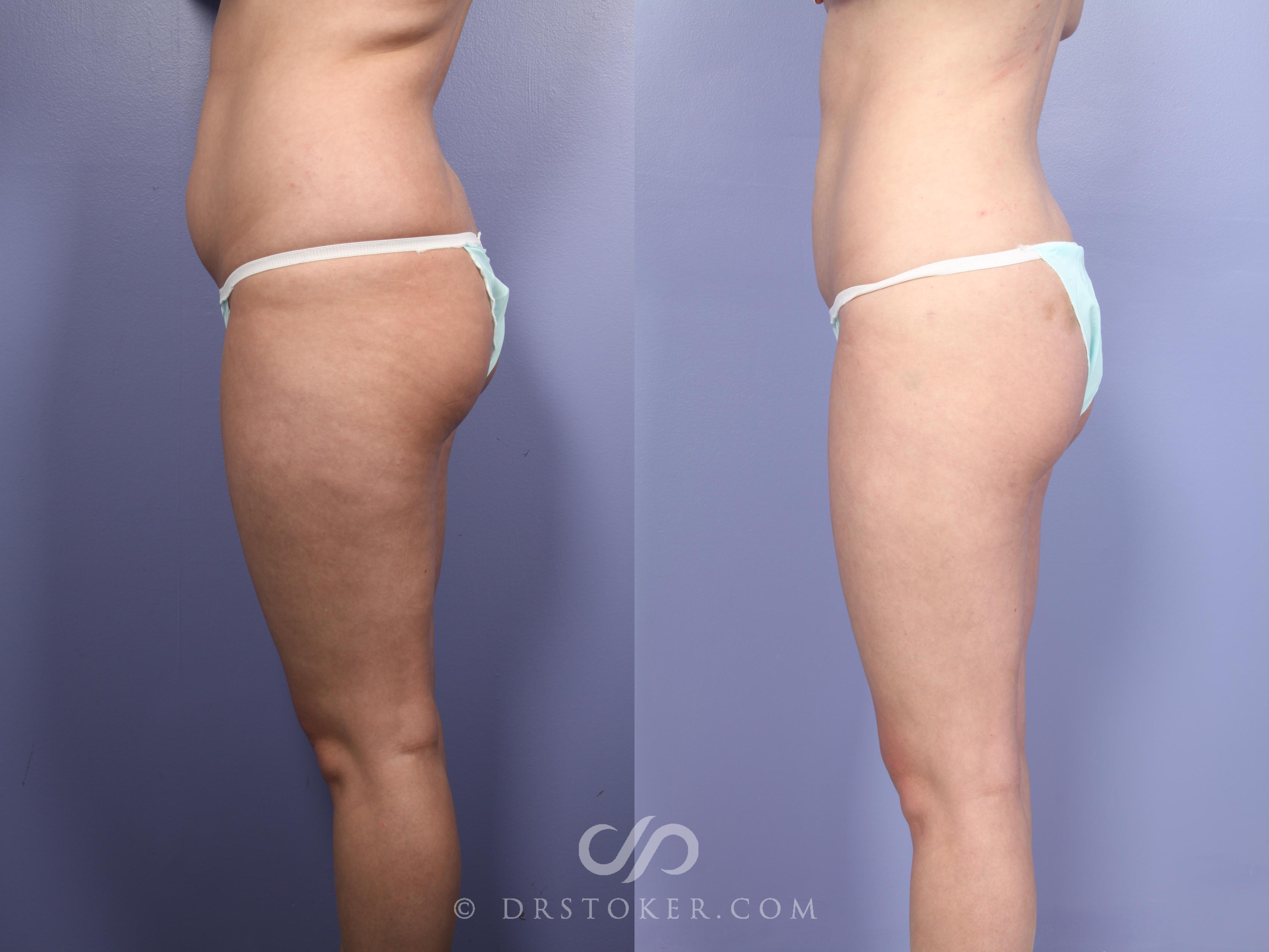 Before & After Liposuction Case 512 View #7 View in Los Angeles, CA