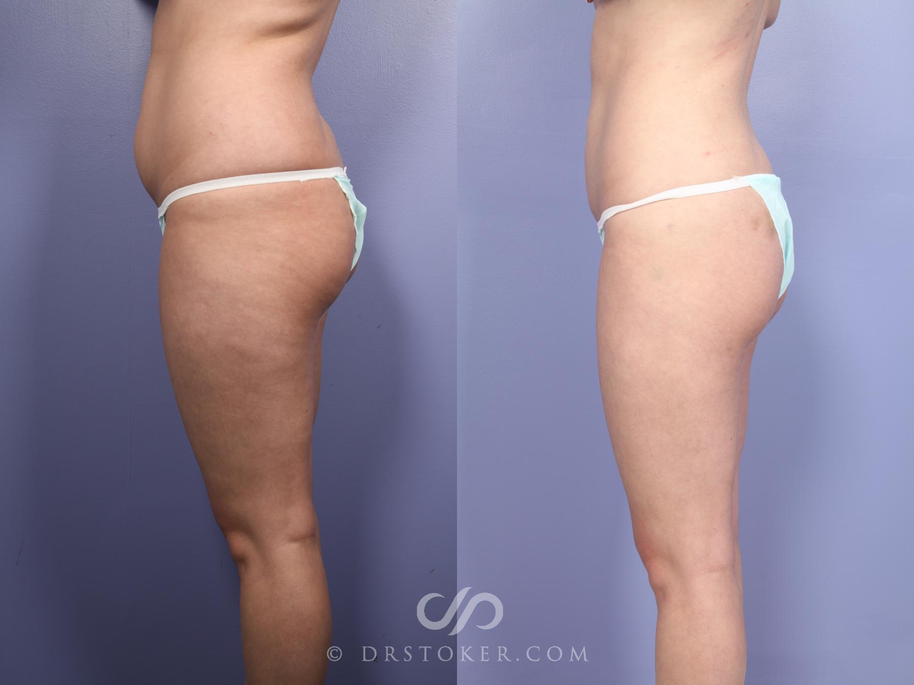 Before & After Liposuction Case 512 View #7 View in Los Angeles, CA