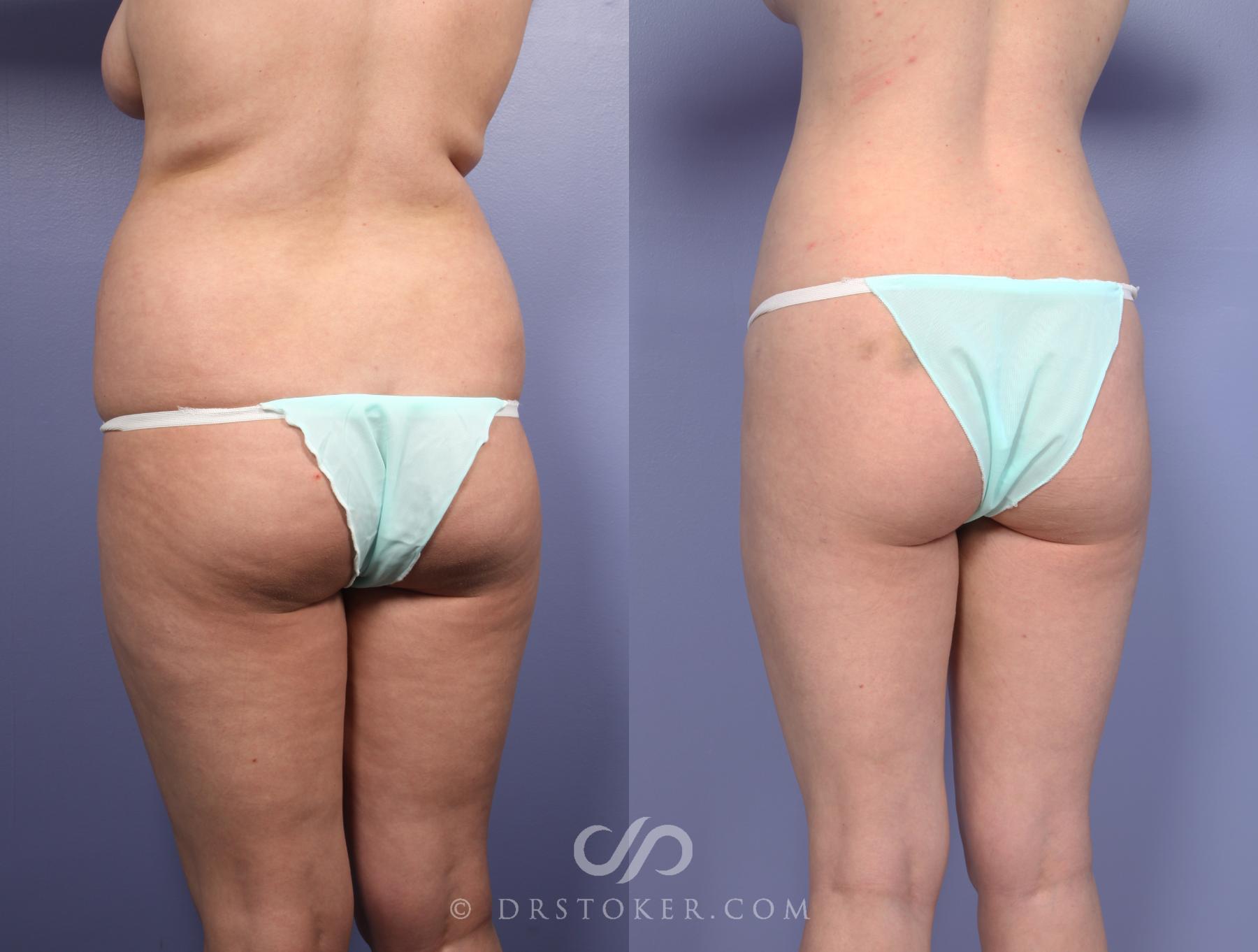Before & After Liposuction Case 512 View #8 View in Los Angeles, CA
