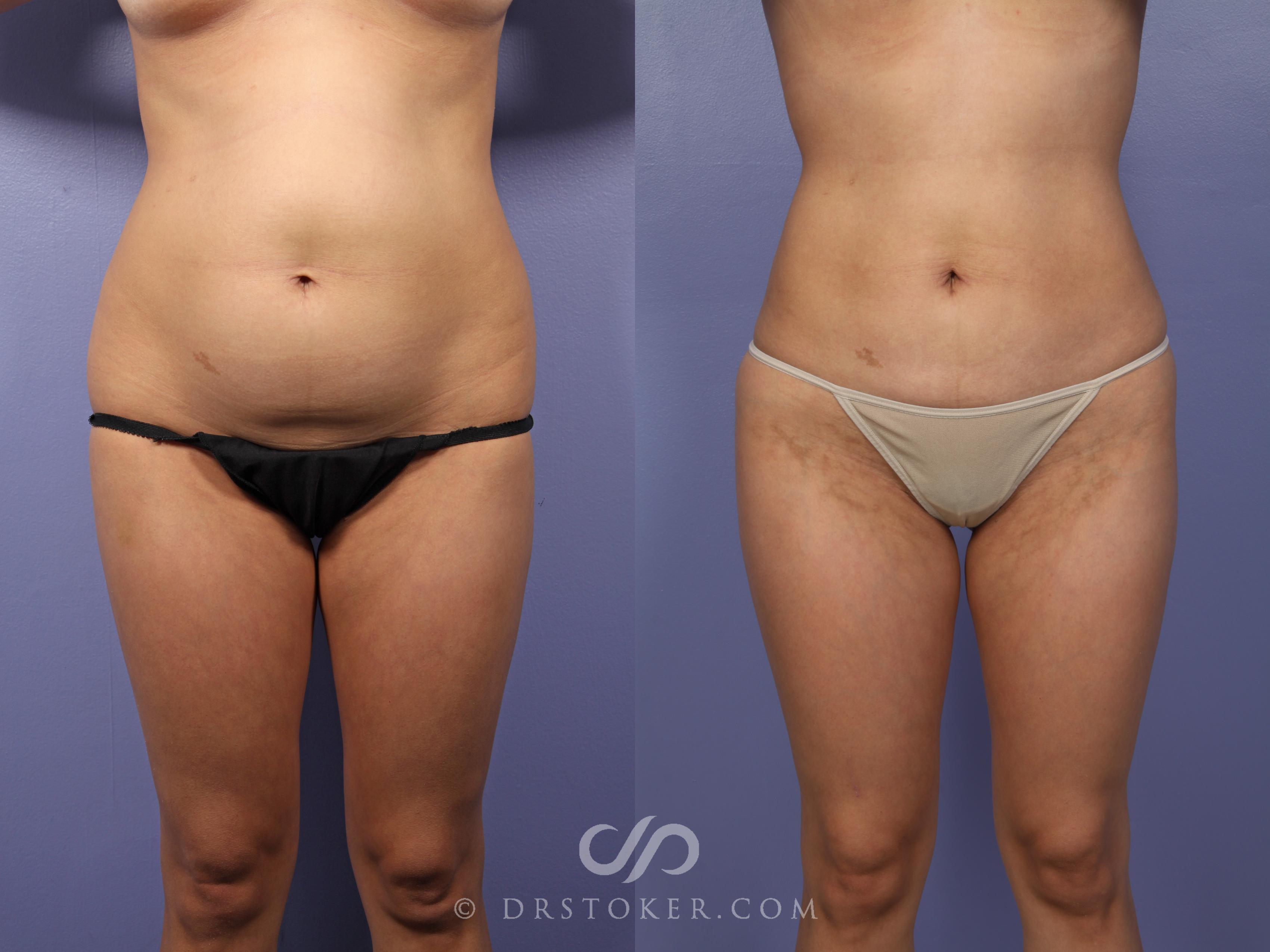 Before & After Liposuction Case 513 View #1 View in Los Angeles, CA