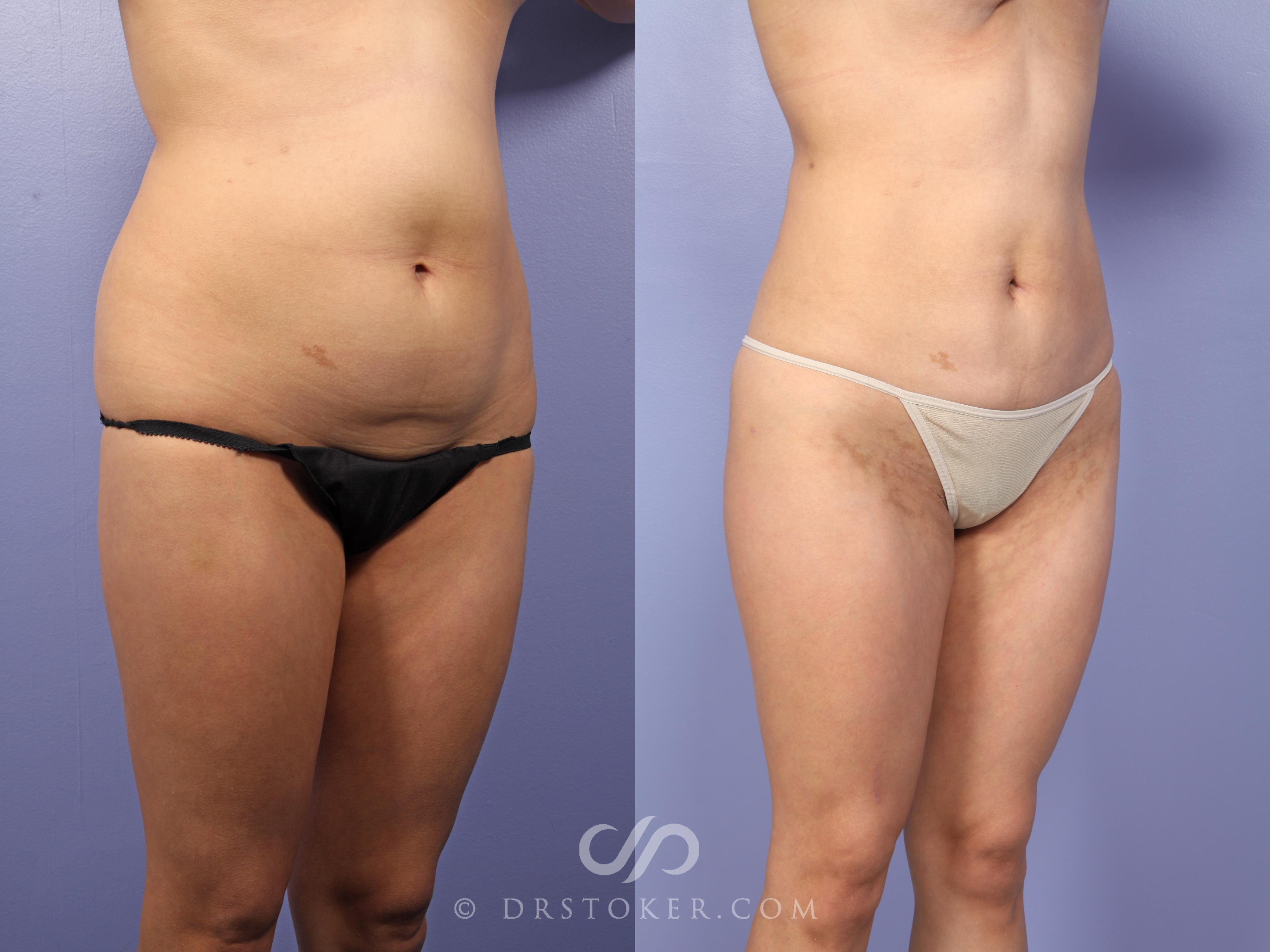 Before & After Liposuction Case 513 View #3 View in Los Angeles, CA