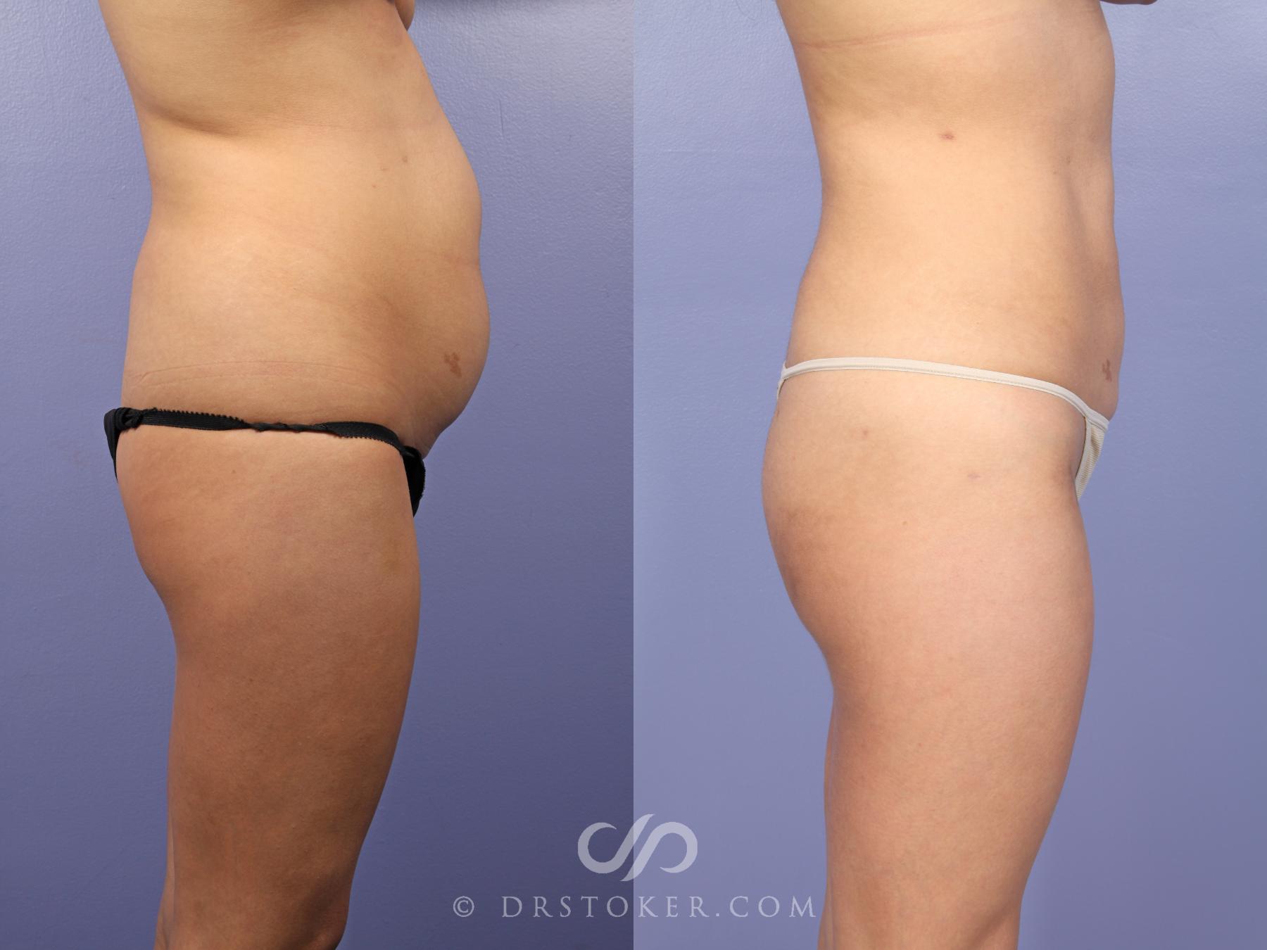 Before & After Liposuction Case 513 View #4 View in Los Angeles, CA