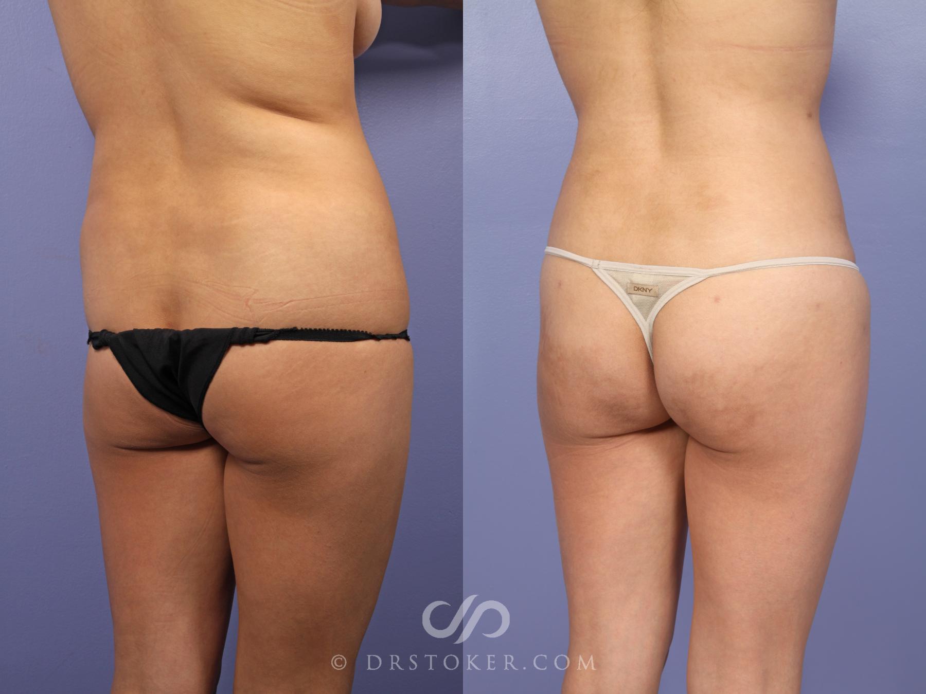 Before & After Liposuction Case 513 View #5 View in Los Angeles, CA