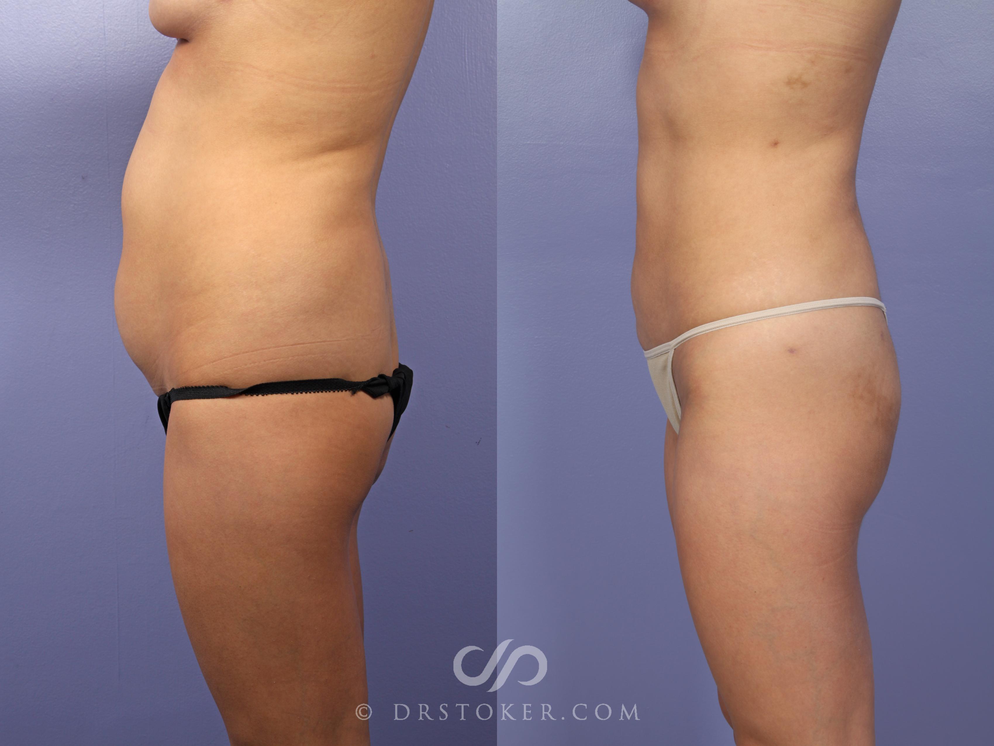 Before & After Liposuction Case 513 View #7 View in Los Angeles, CA