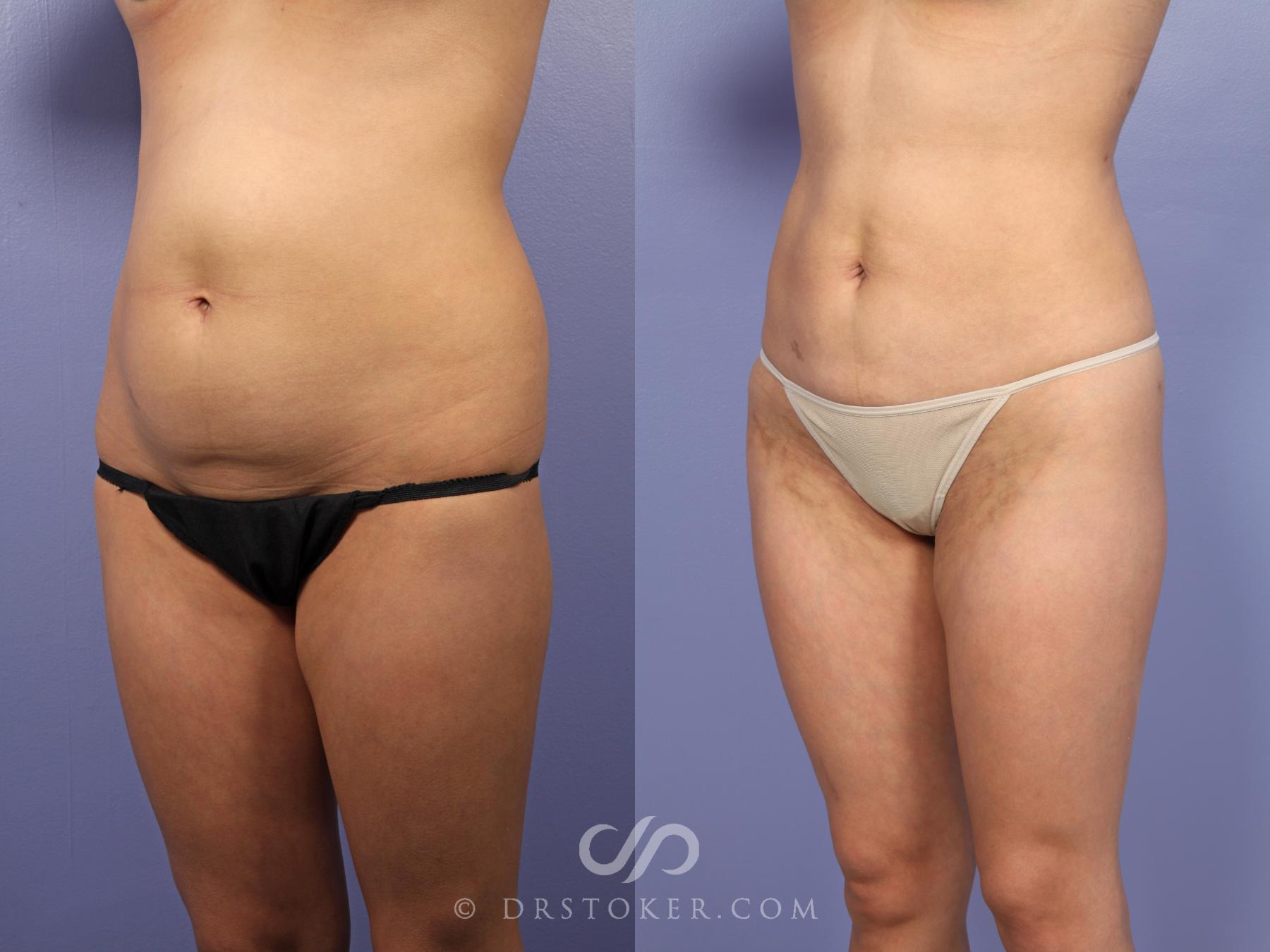 Before & After Liposuction Case 513 View #8 View in Los Angeles, CA