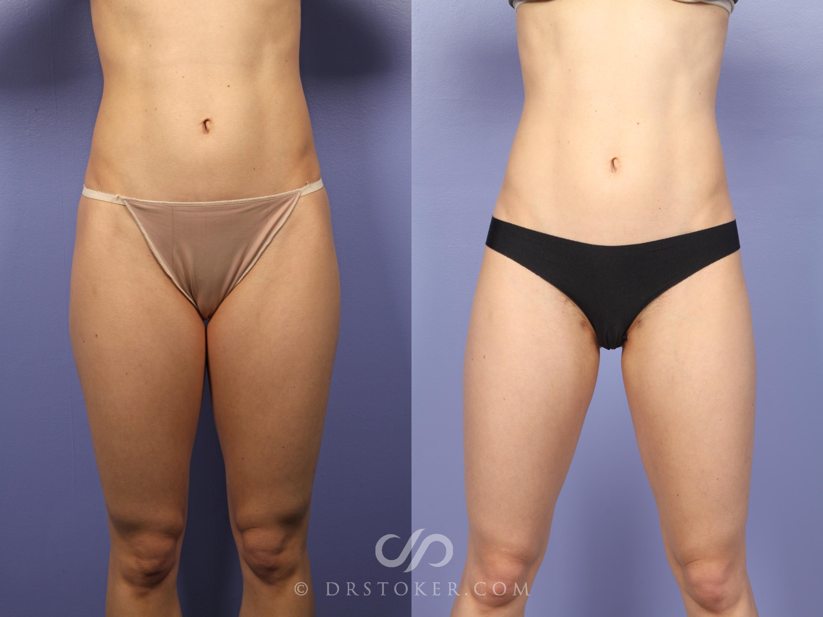 Before & After Liposuction Case 533 View #1 View in Los Angeles, CA