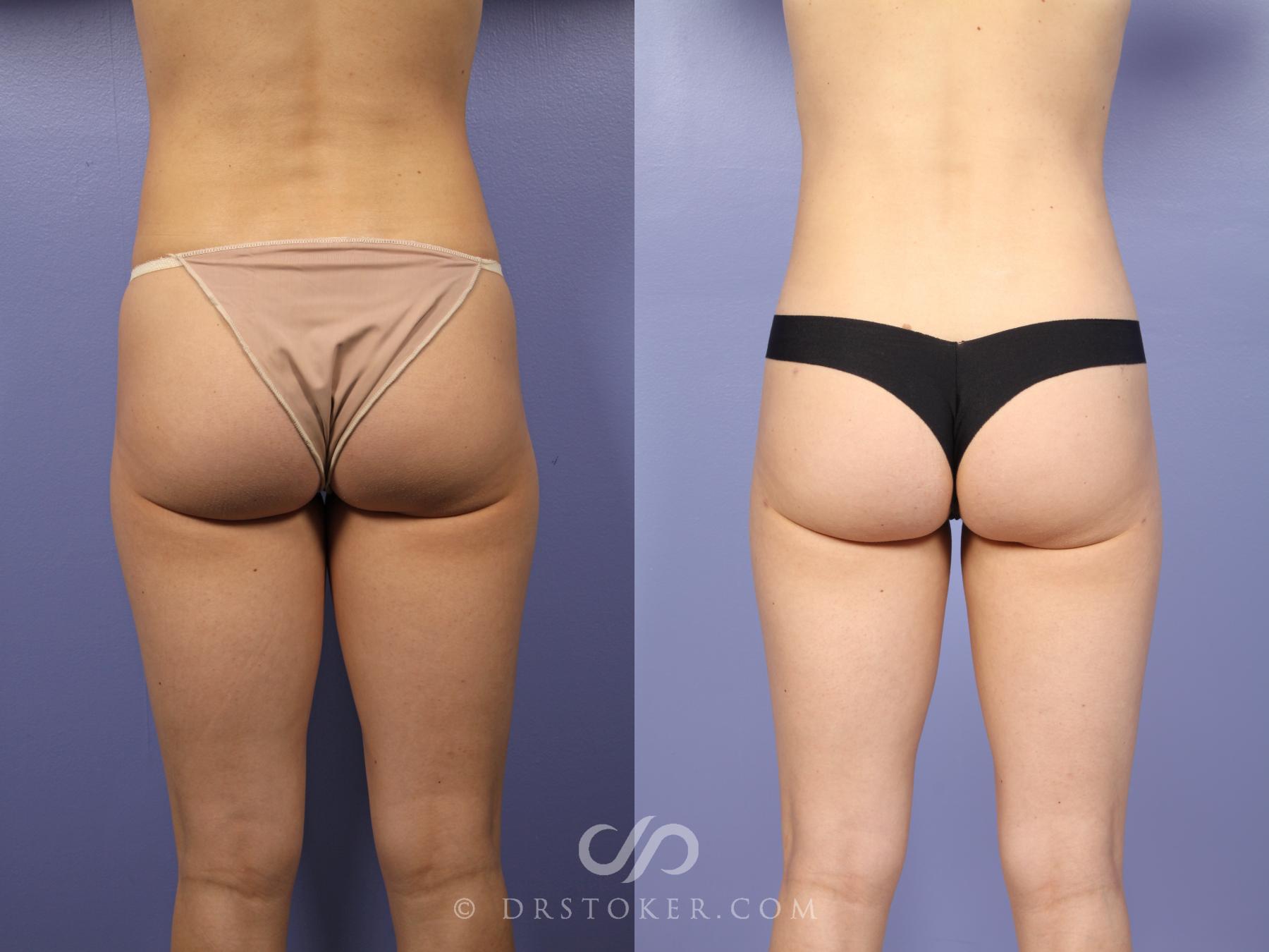Before & After Liposuction Case 533 View #2 View in Los Angeles, CA