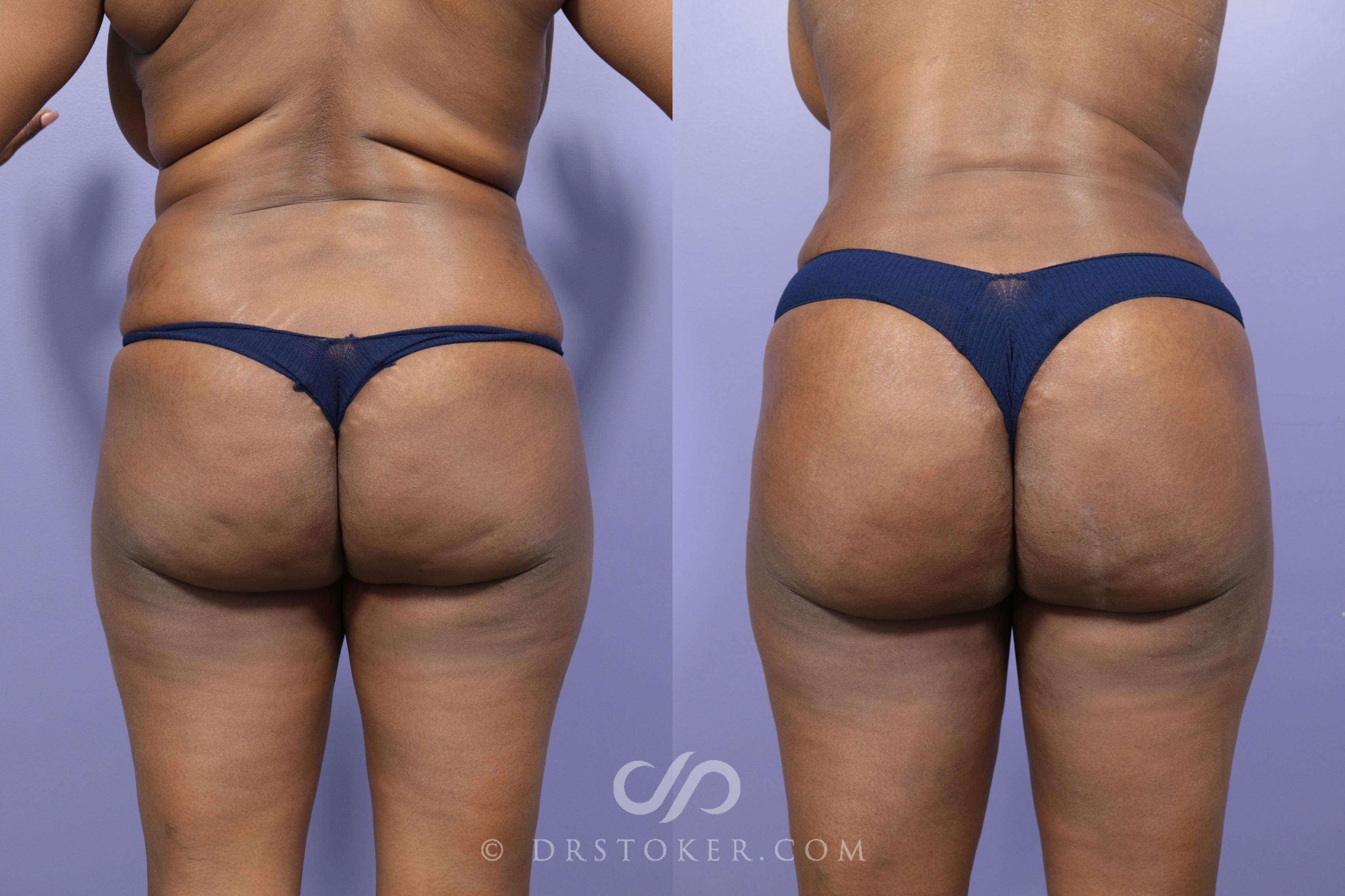 Before & After Liposuction Case 559 View #1 View in Los Angeles, CA