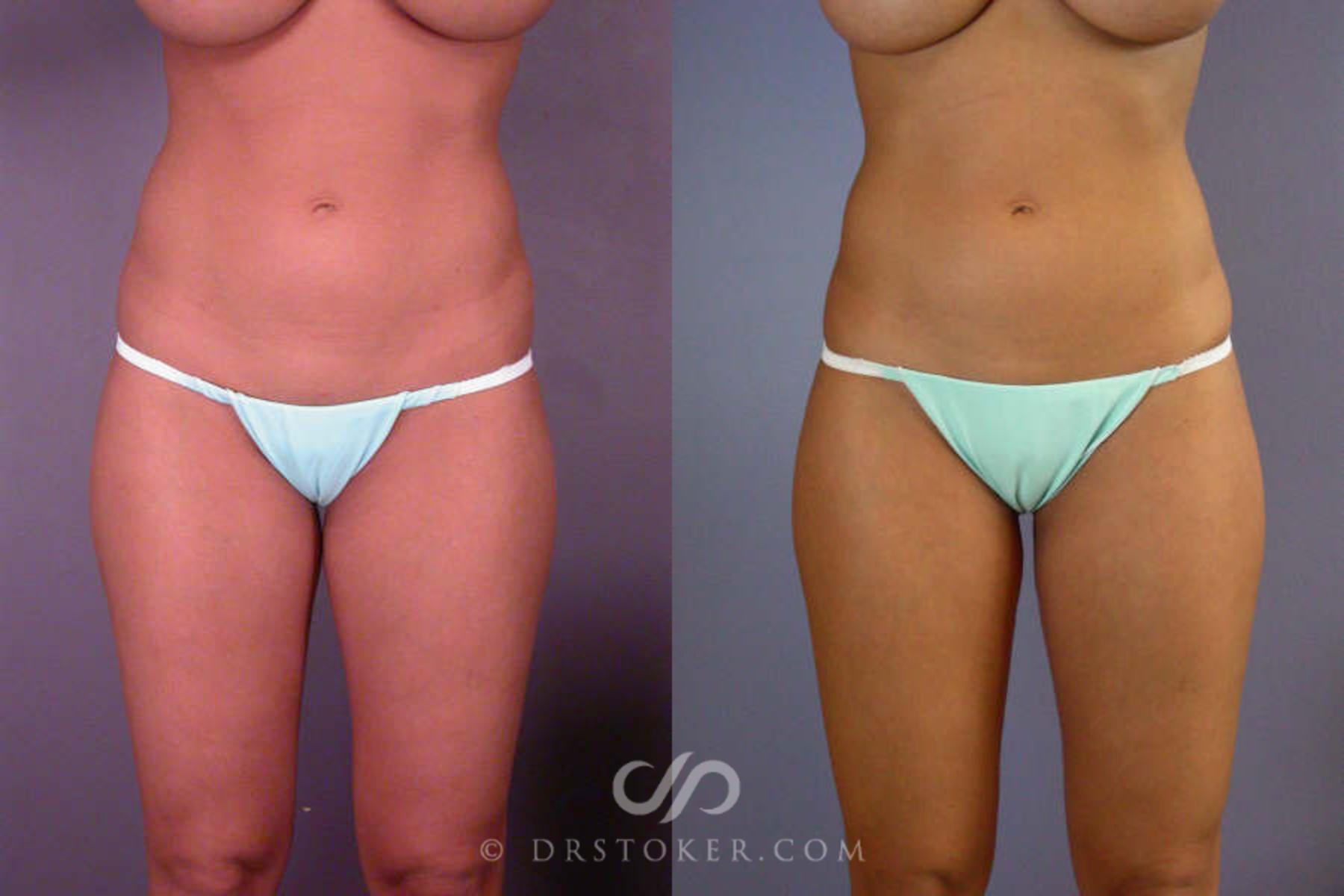 Before & After Liposuction Case 85 View #1 View in Los Angeles, CA