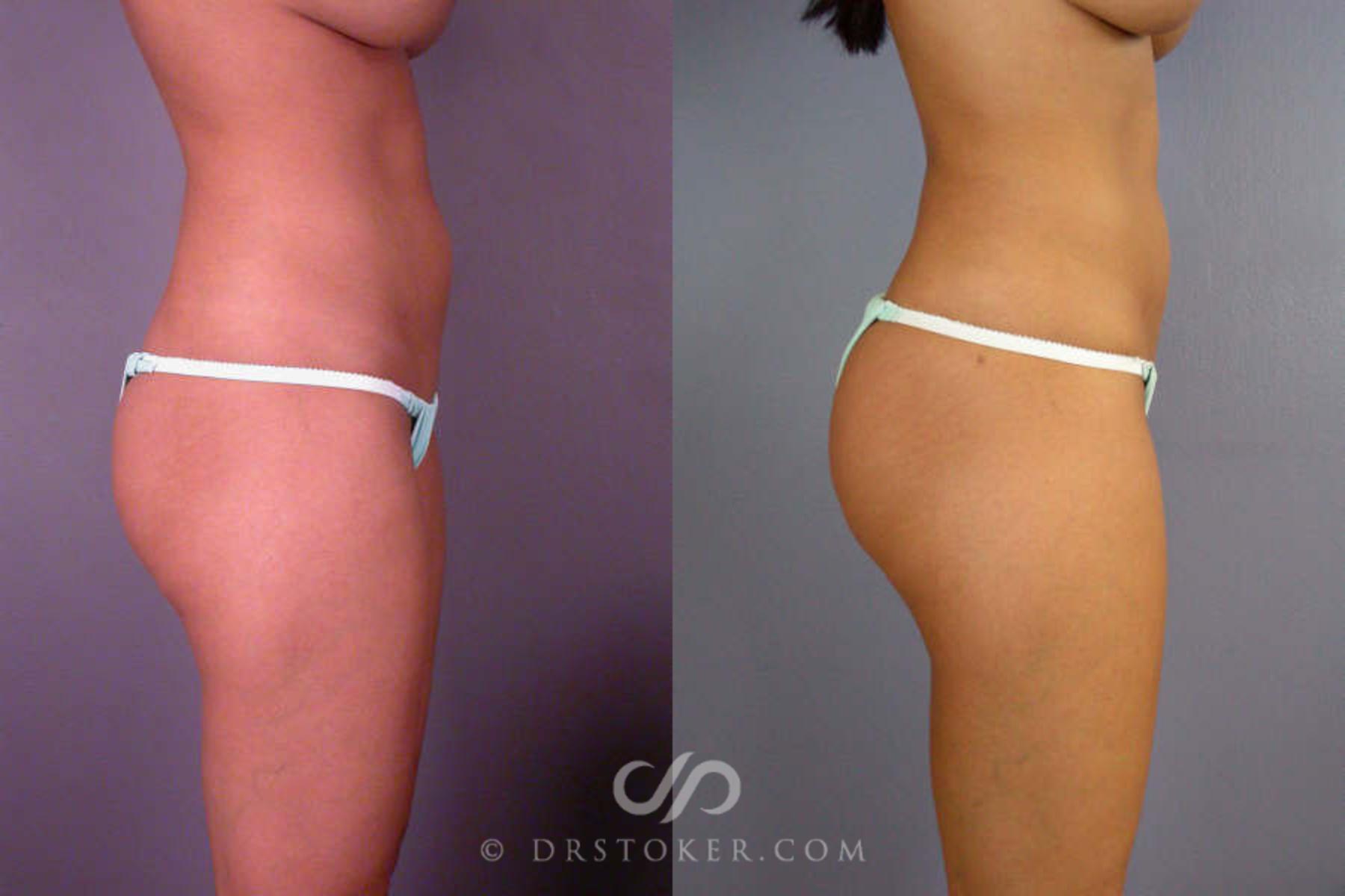Before & After Liposuction Case 85 View #2 View in Los Angeles, CA