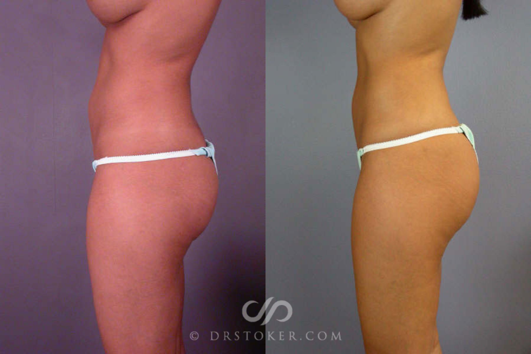 Before & After Liposuction Case 85 View #3 View in Los Angeles, CA
