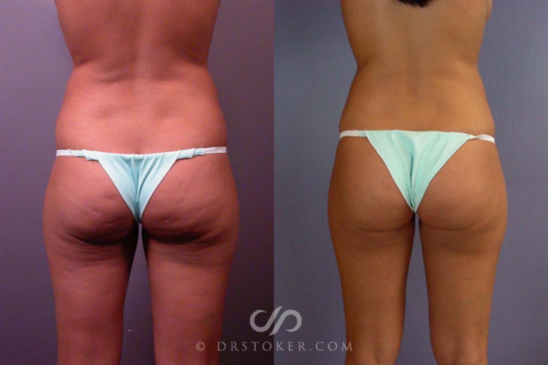 Before & After Liposuction Case 85 View #4 View in Los Angeles, CA