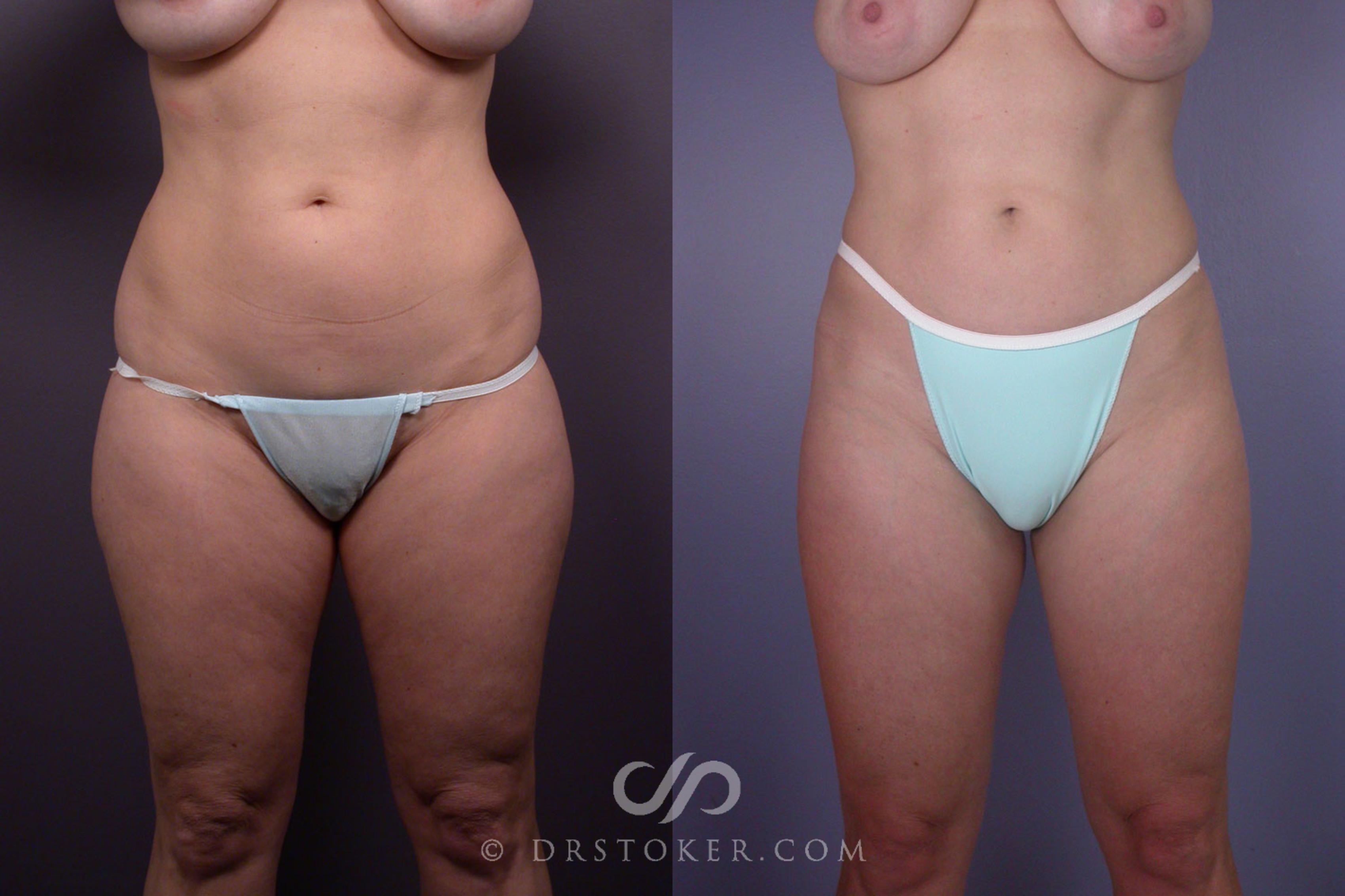 Before & After Liposuction Case 90 View #1 View in Los Angeles, CA