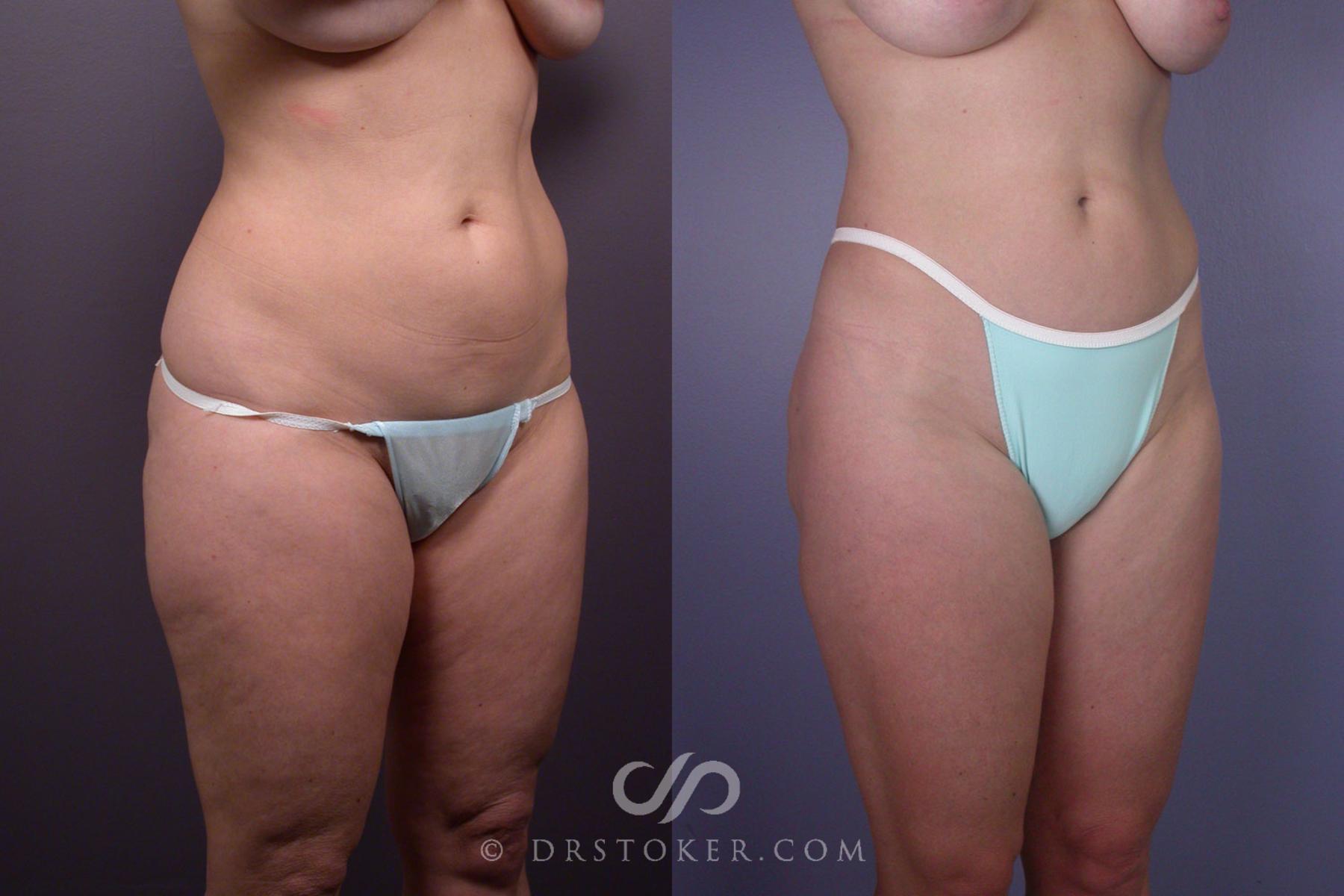 Before & After Liposuction Case 90 View #2 View in Los Angeles, CA