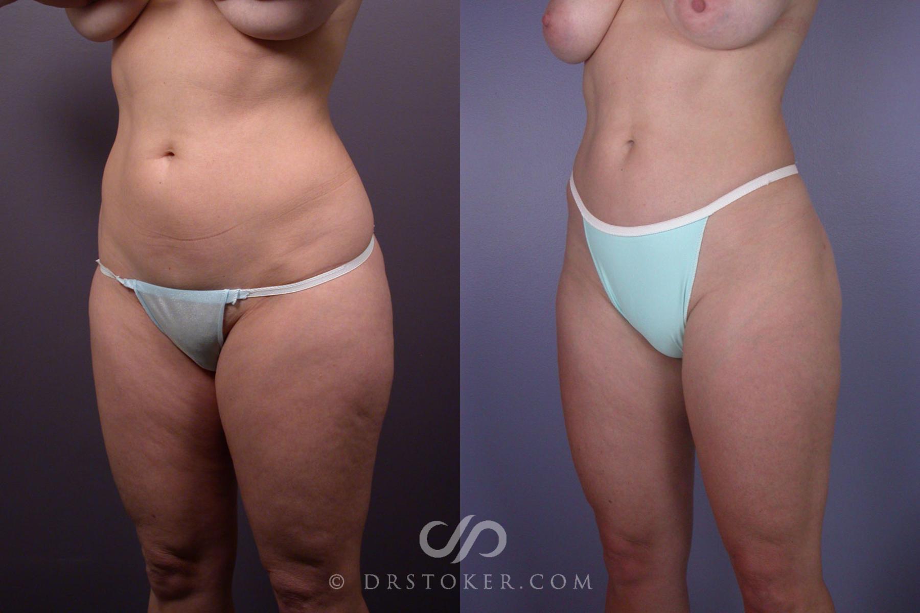 Before & After Liposuction Case 90 View #3 View in Los Angeles, CA