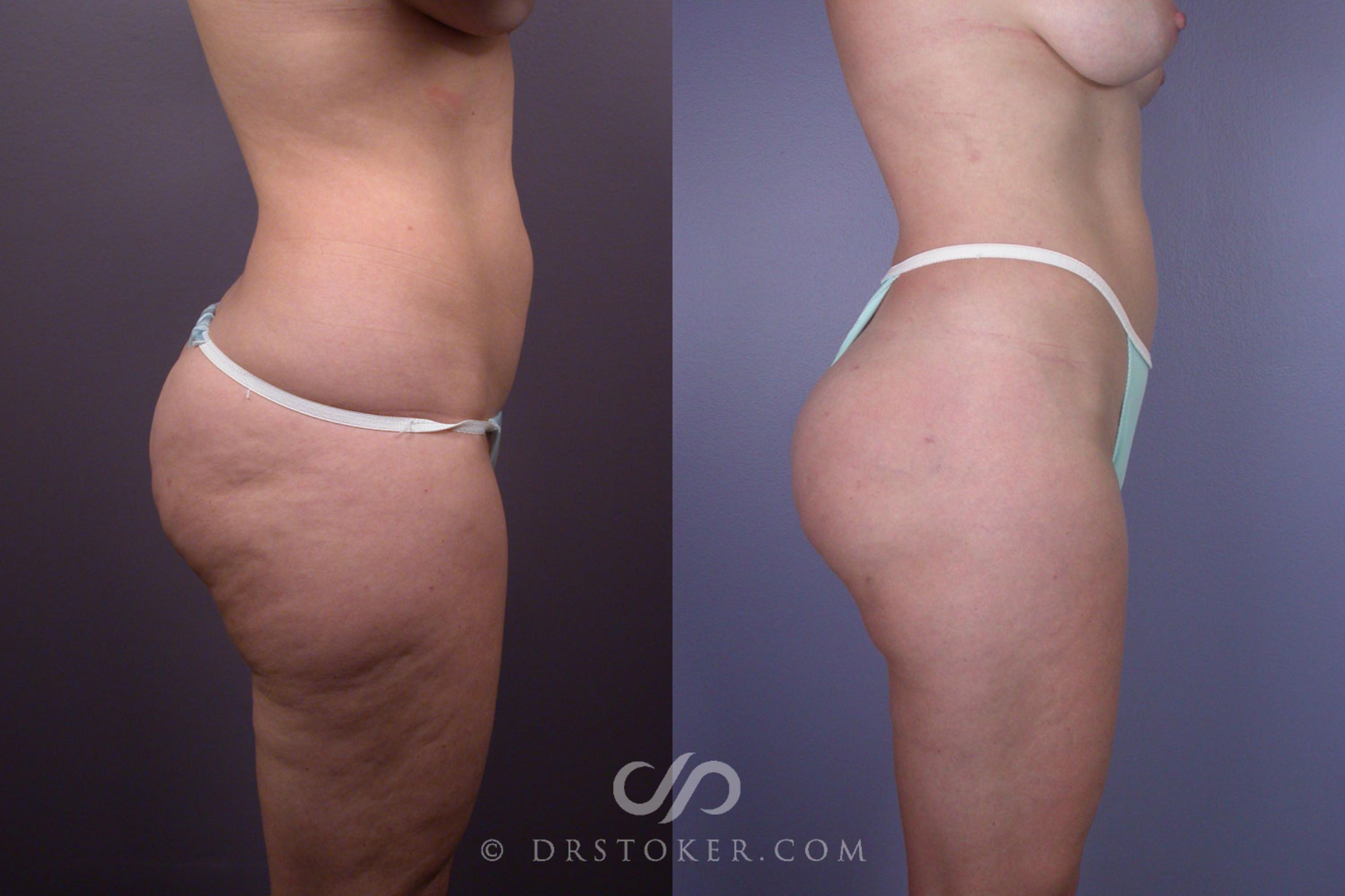 Before & After Liposuction Case 90 View #4 View in Los Angeles, CA